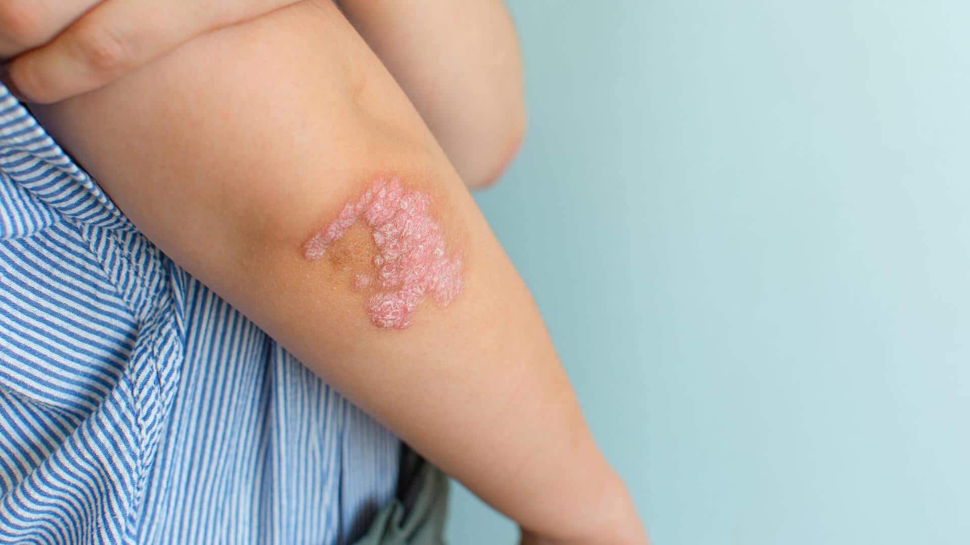 Psoriasis: Manage your symptoms with these home remedies