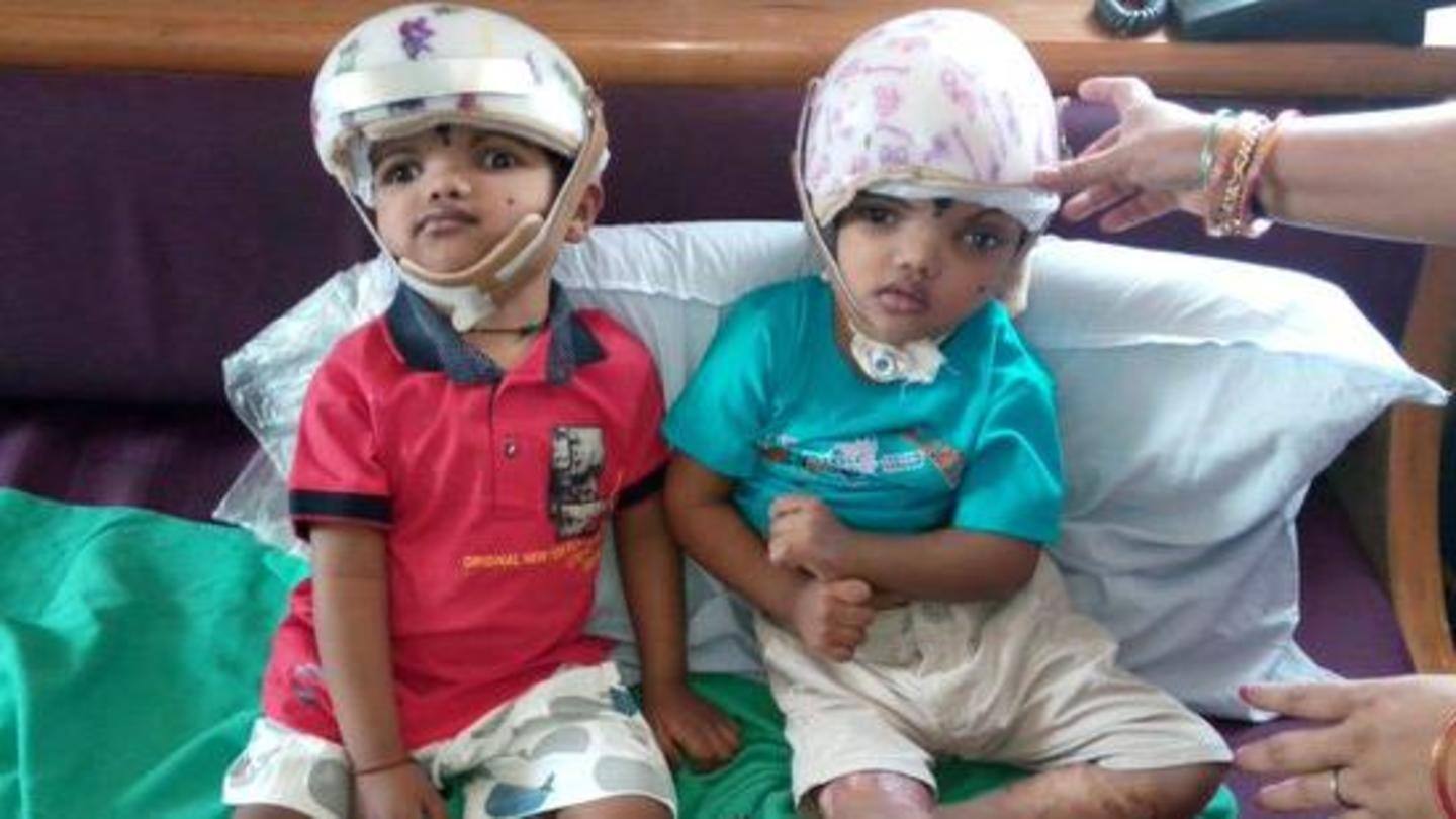 Odisha: One of separated conjoined twins returns home
