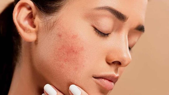 All you need to know about body acne