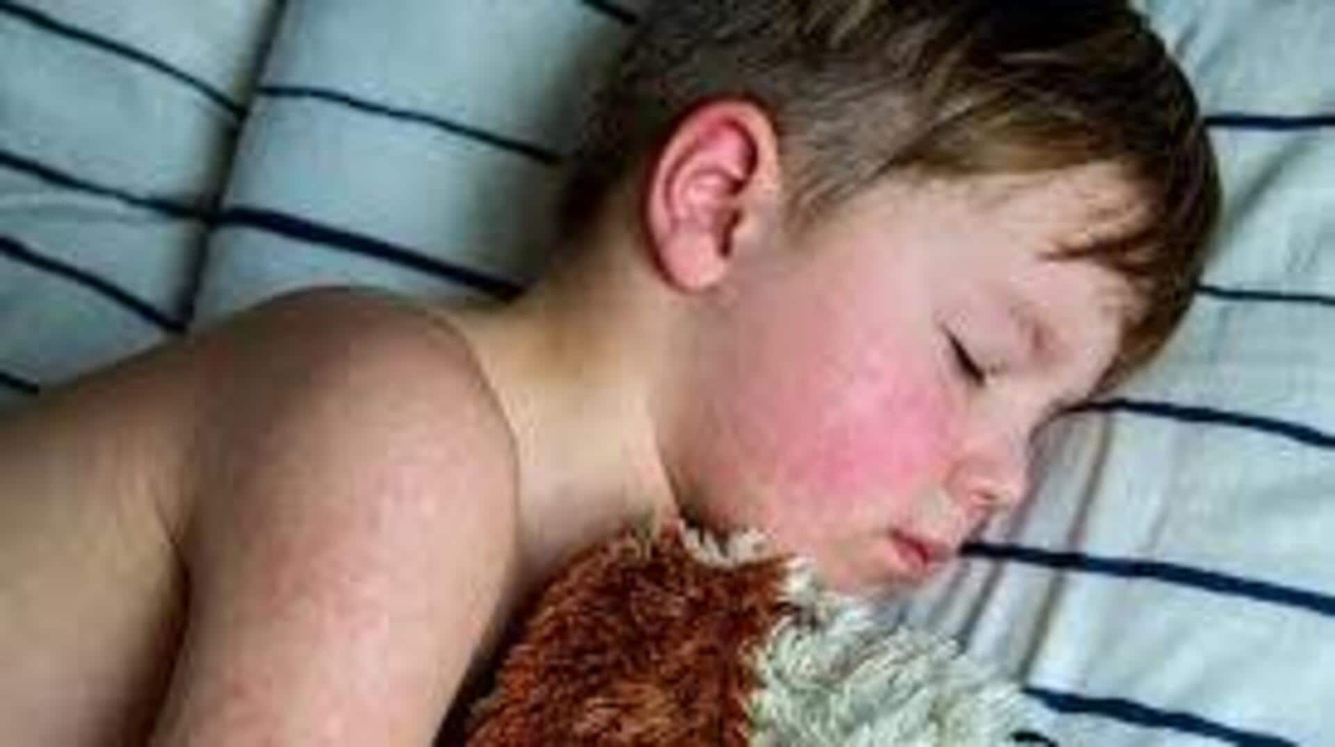 Measles outbreak in US sees 35% surge; Texas hardest hit