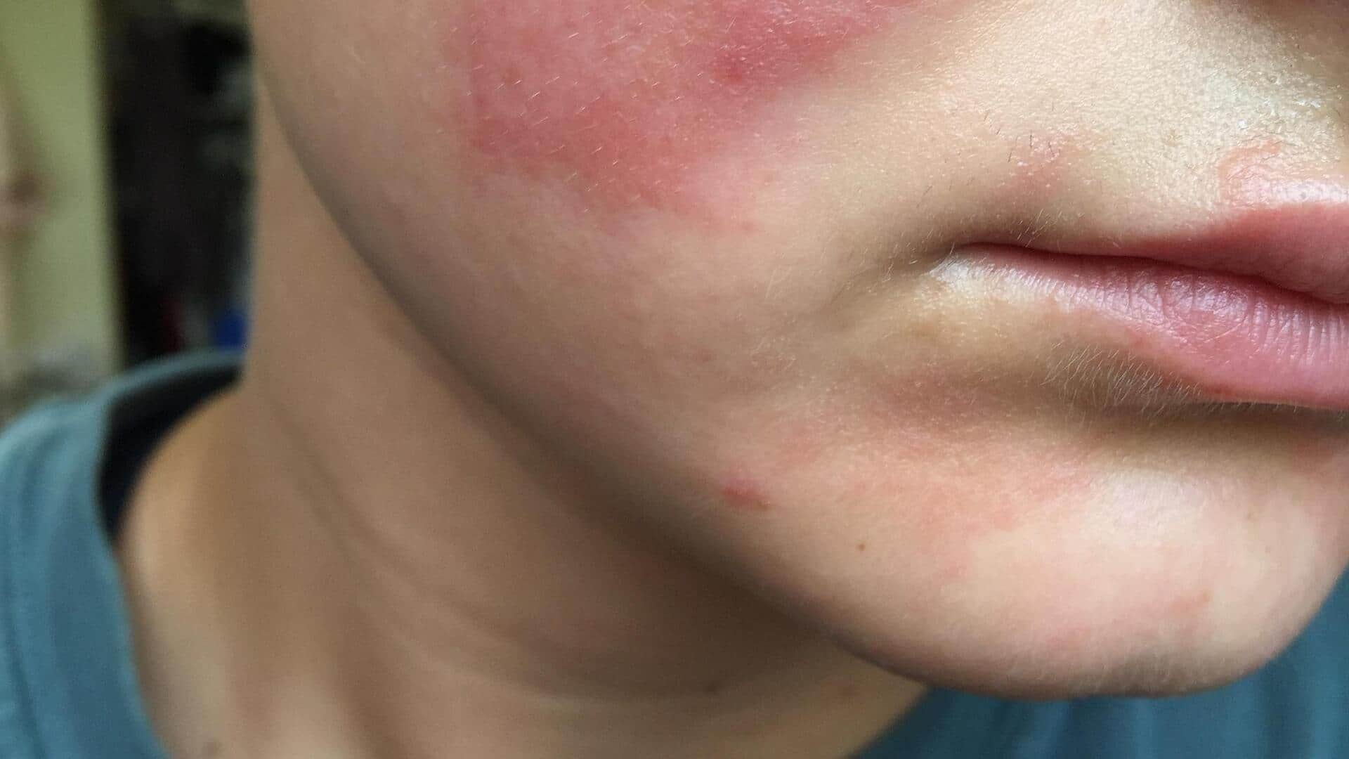 Fix cheek burning with these home remedies