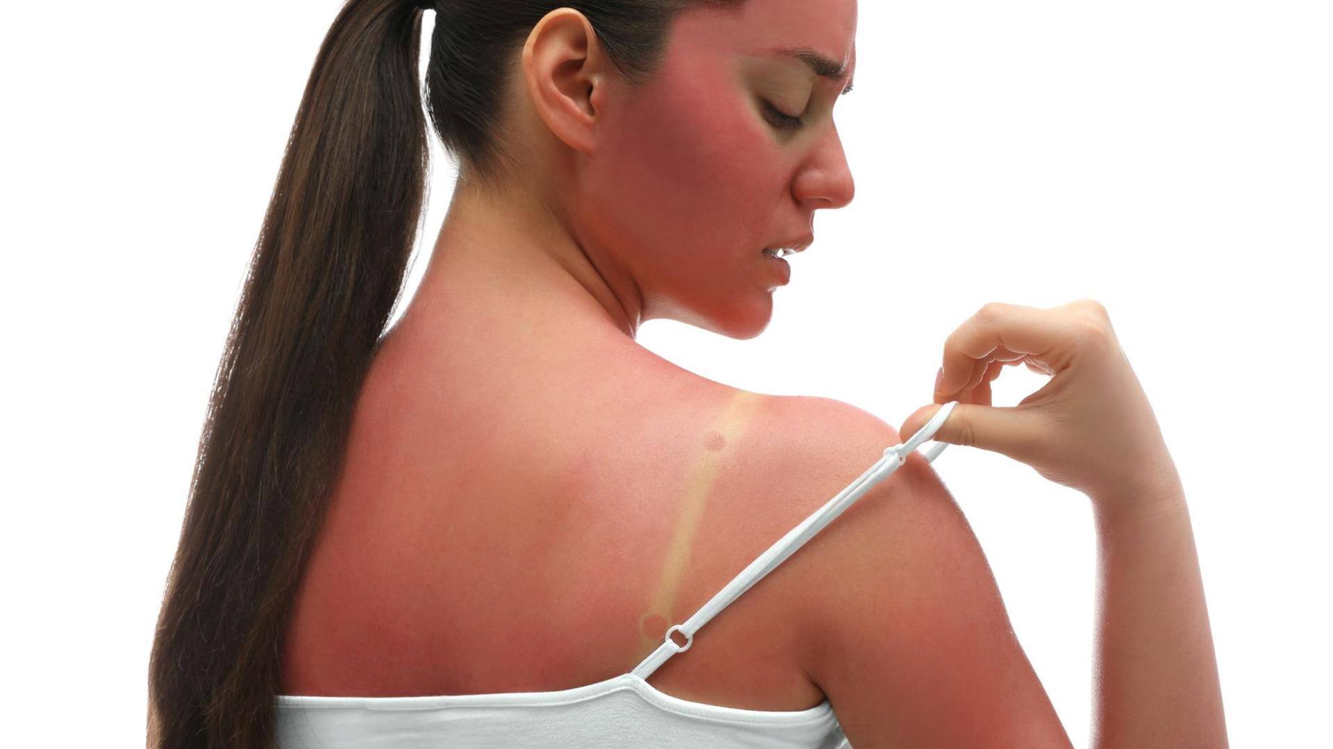 Got a sunburn? These effective natural home remedies can help