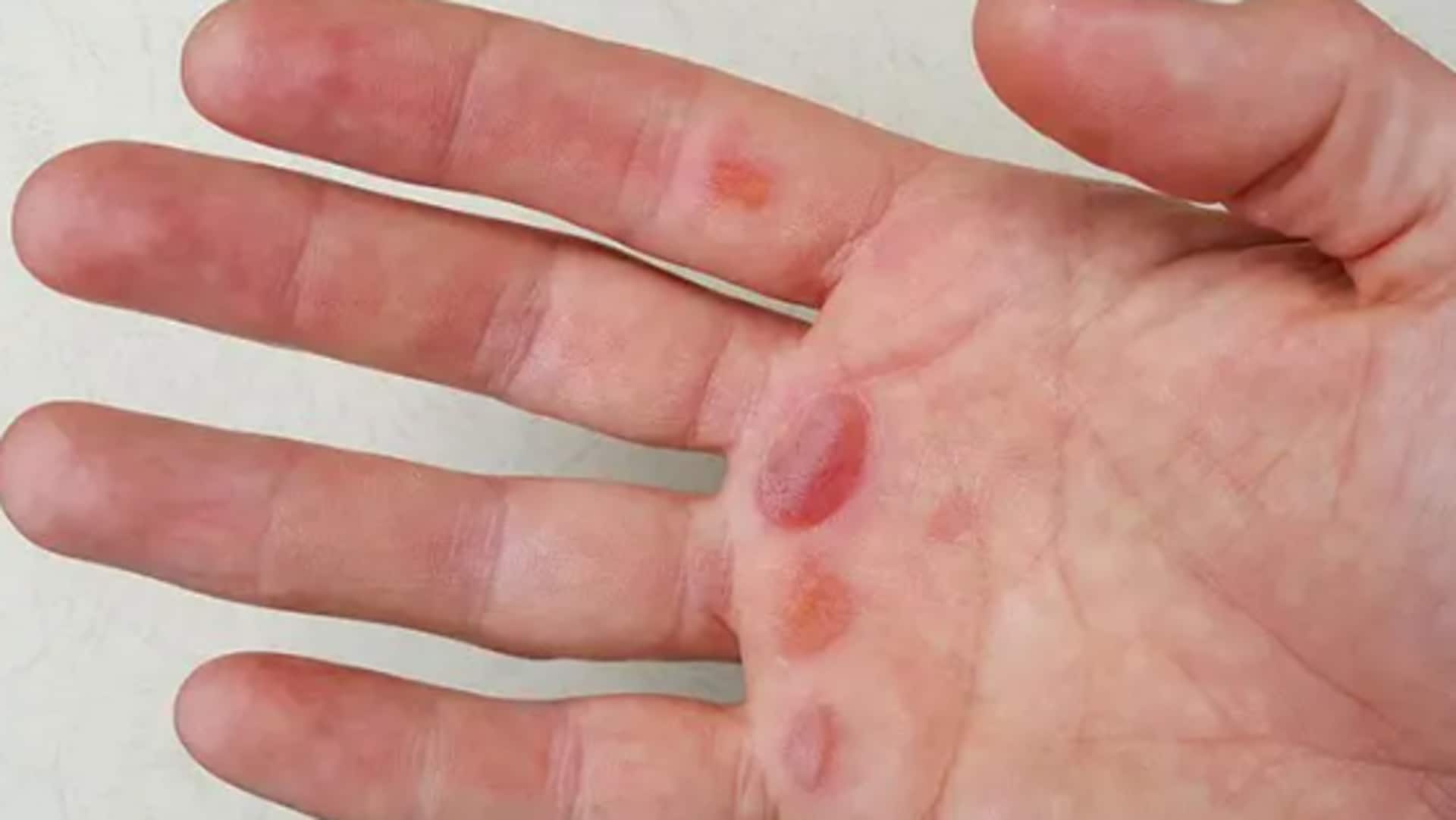 Say goodbye to blisters with these simple remedies Say goodbye to blisters with these simple remedies