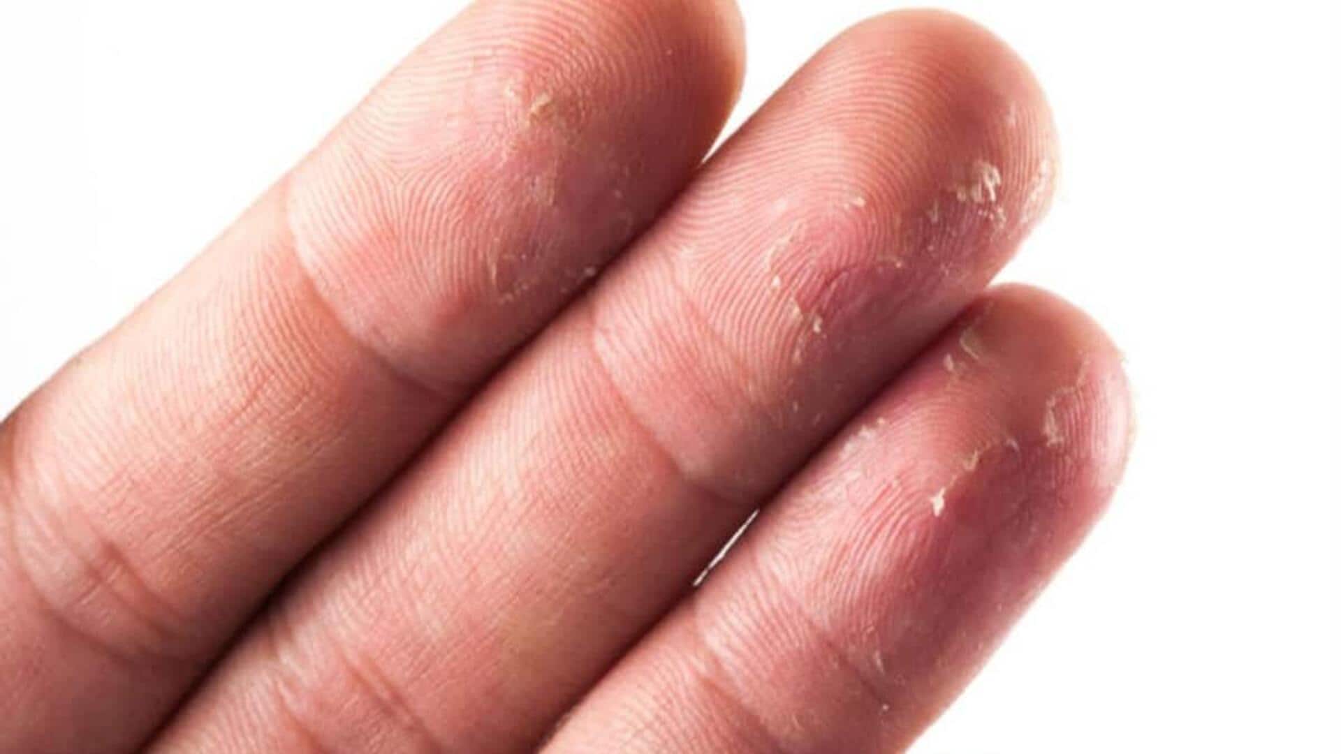 Fix dry finger tips with these simple hacks