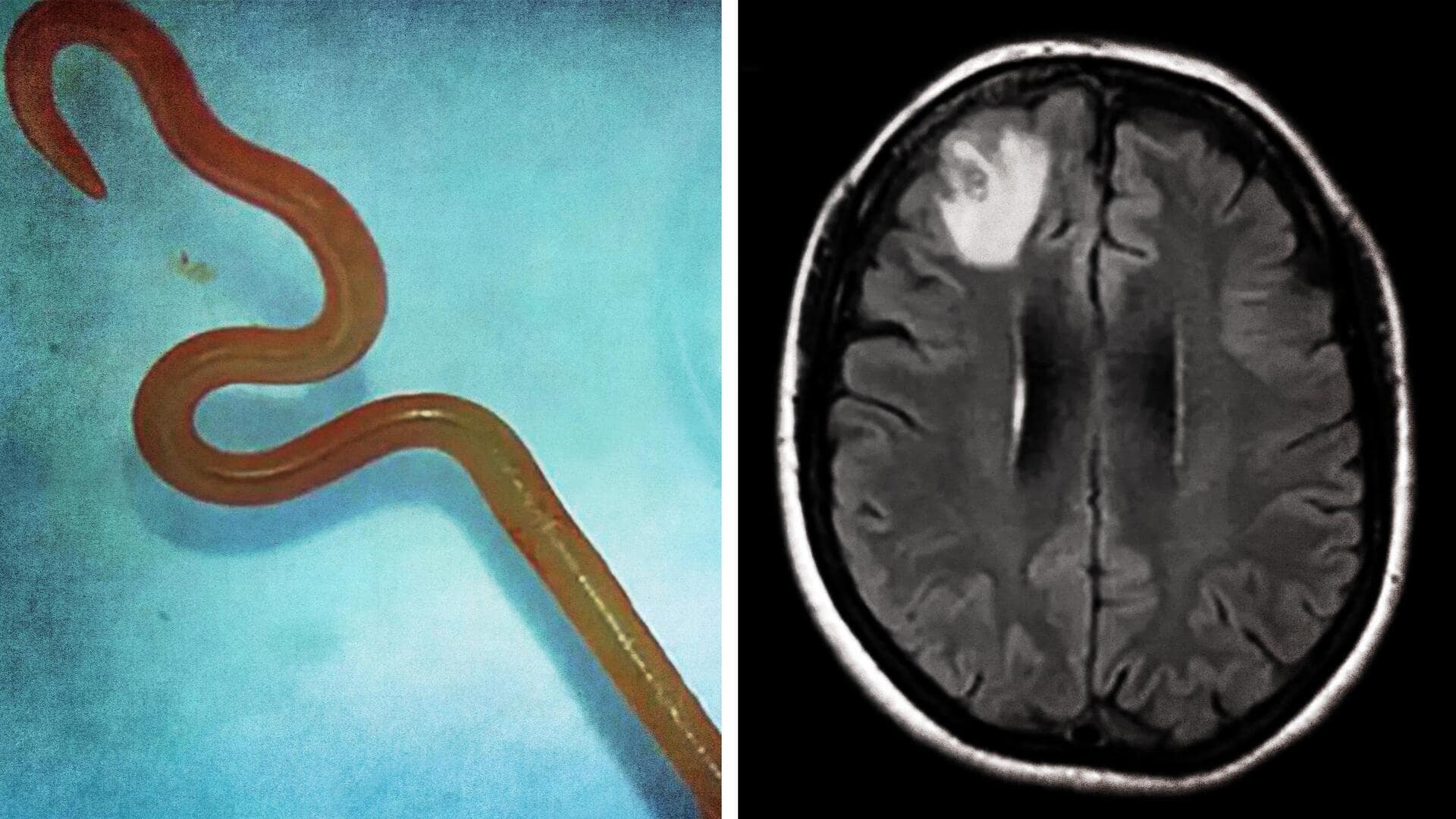World's first: Parasitic worm found alive in woman's brain