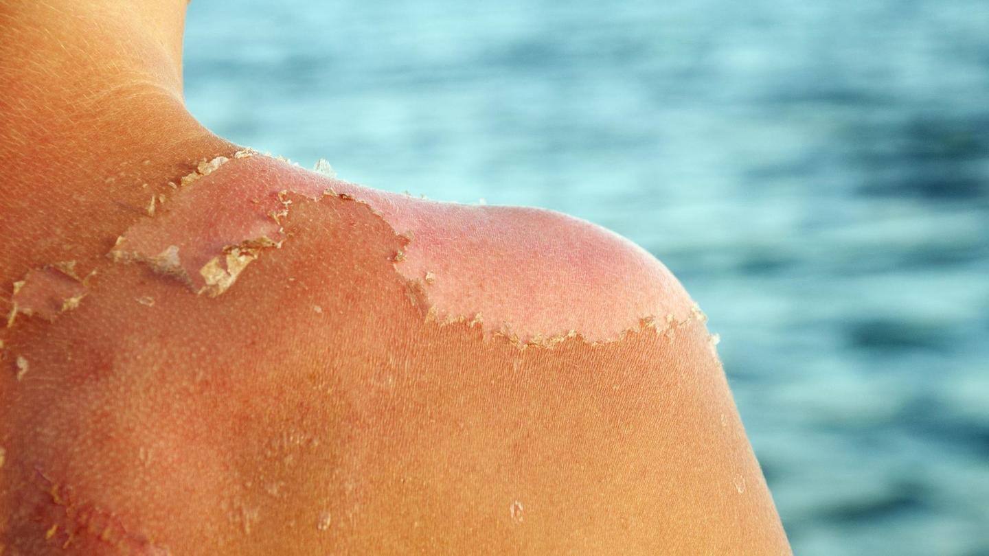 If you suspect sun poisoning, visit your doctor soon If you suspect sun poisoning, visit your doctor soon