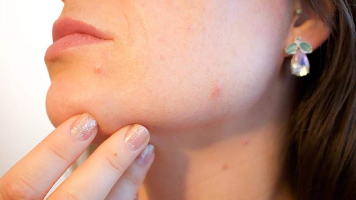 Stress acne can be stressful. Here's how to tackle it