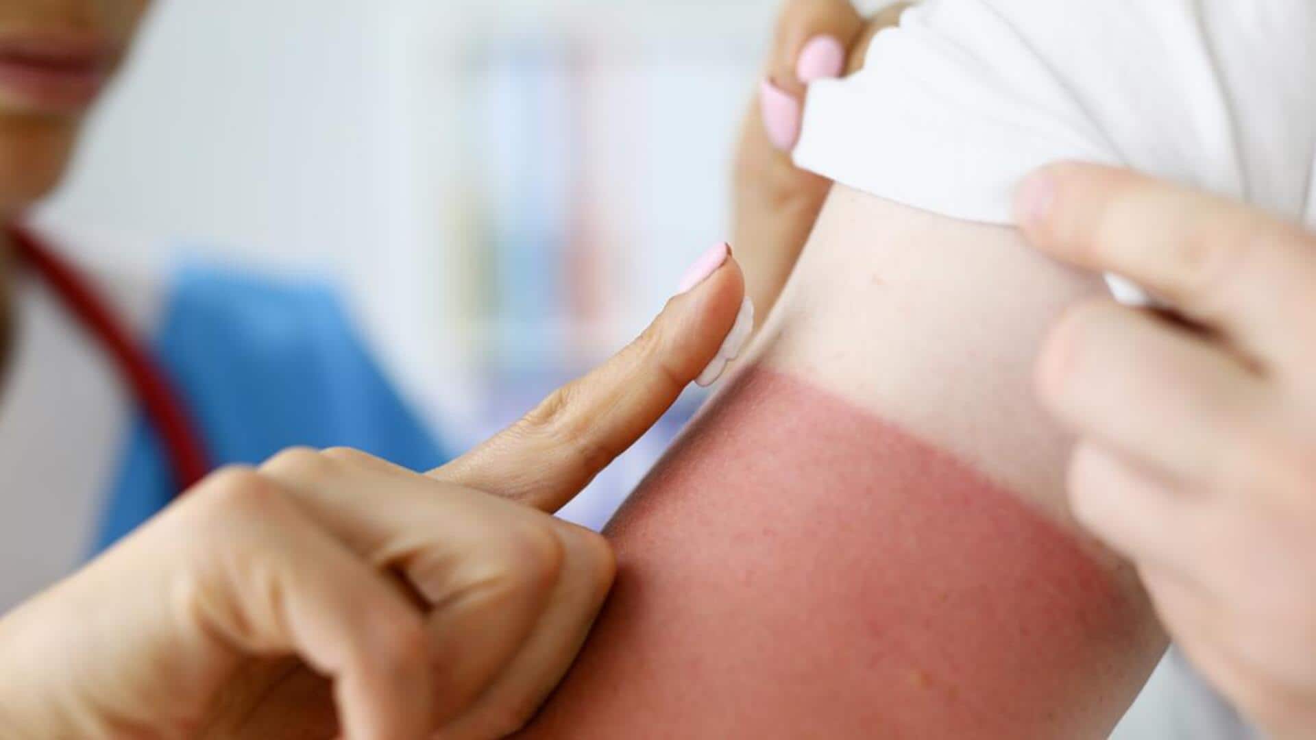 How to fix sunburn naturally How to fix sunburn naturally