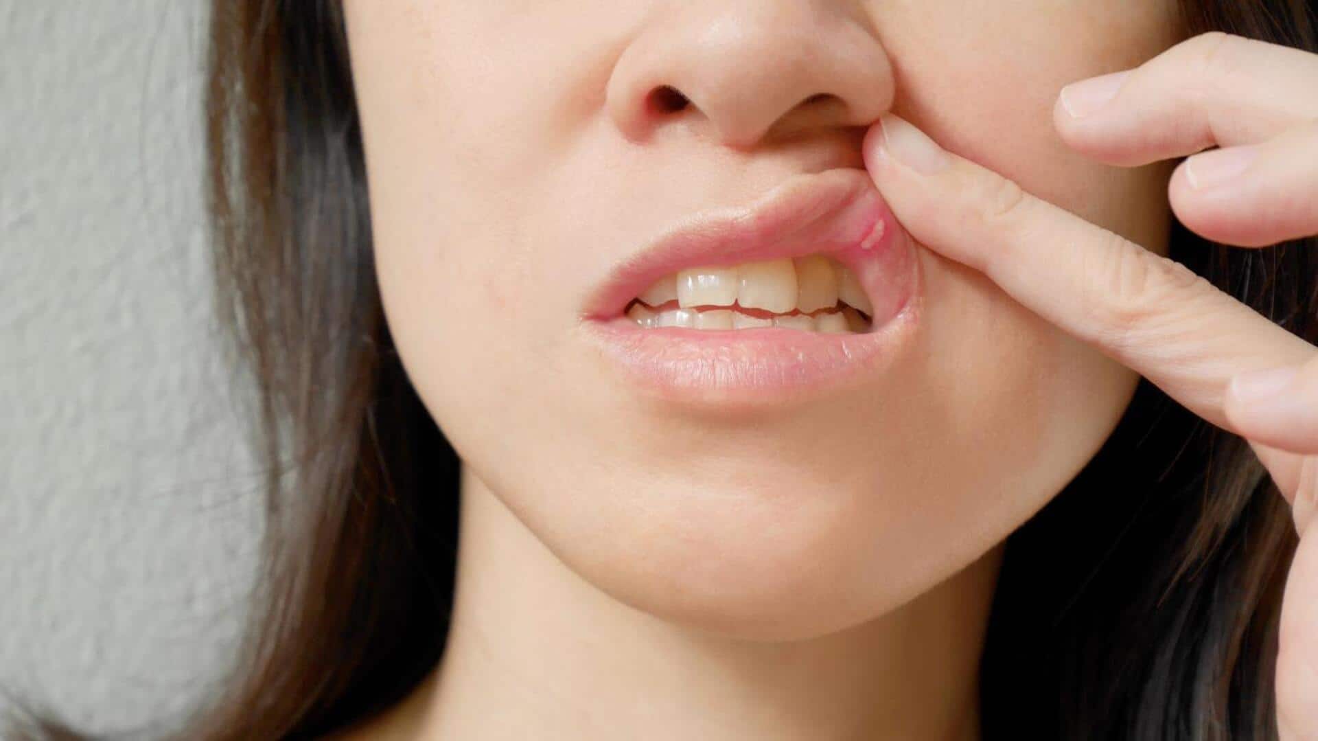 These natural remedies work like magic on mouth ulcers