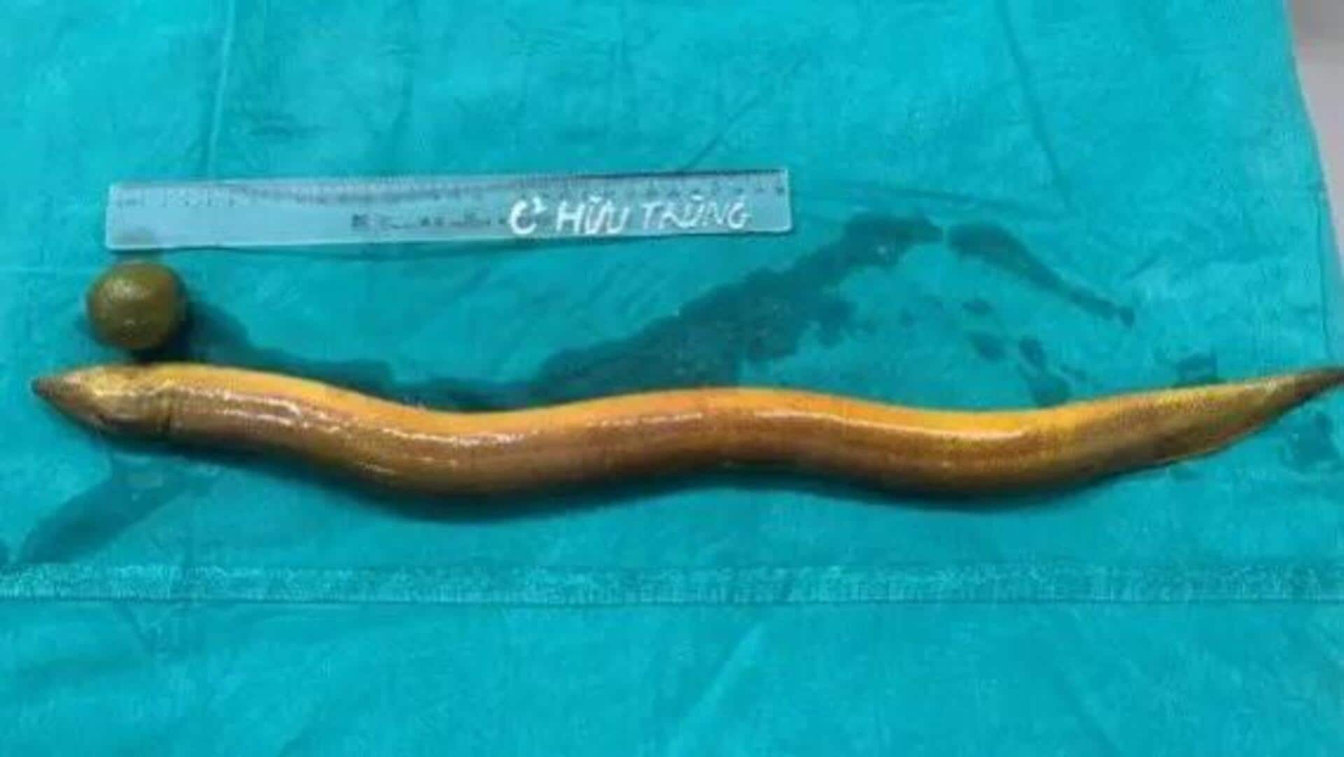 Man inserts 25-inch-long eel up his rectum; it chews intestines