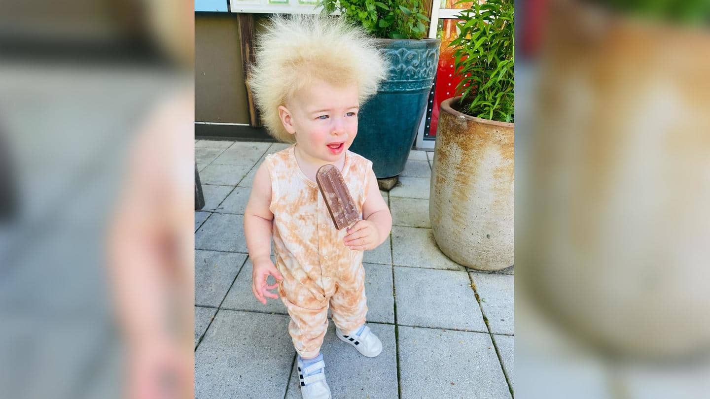 UK toddler's rare condition makes her look like Albert Einstein!