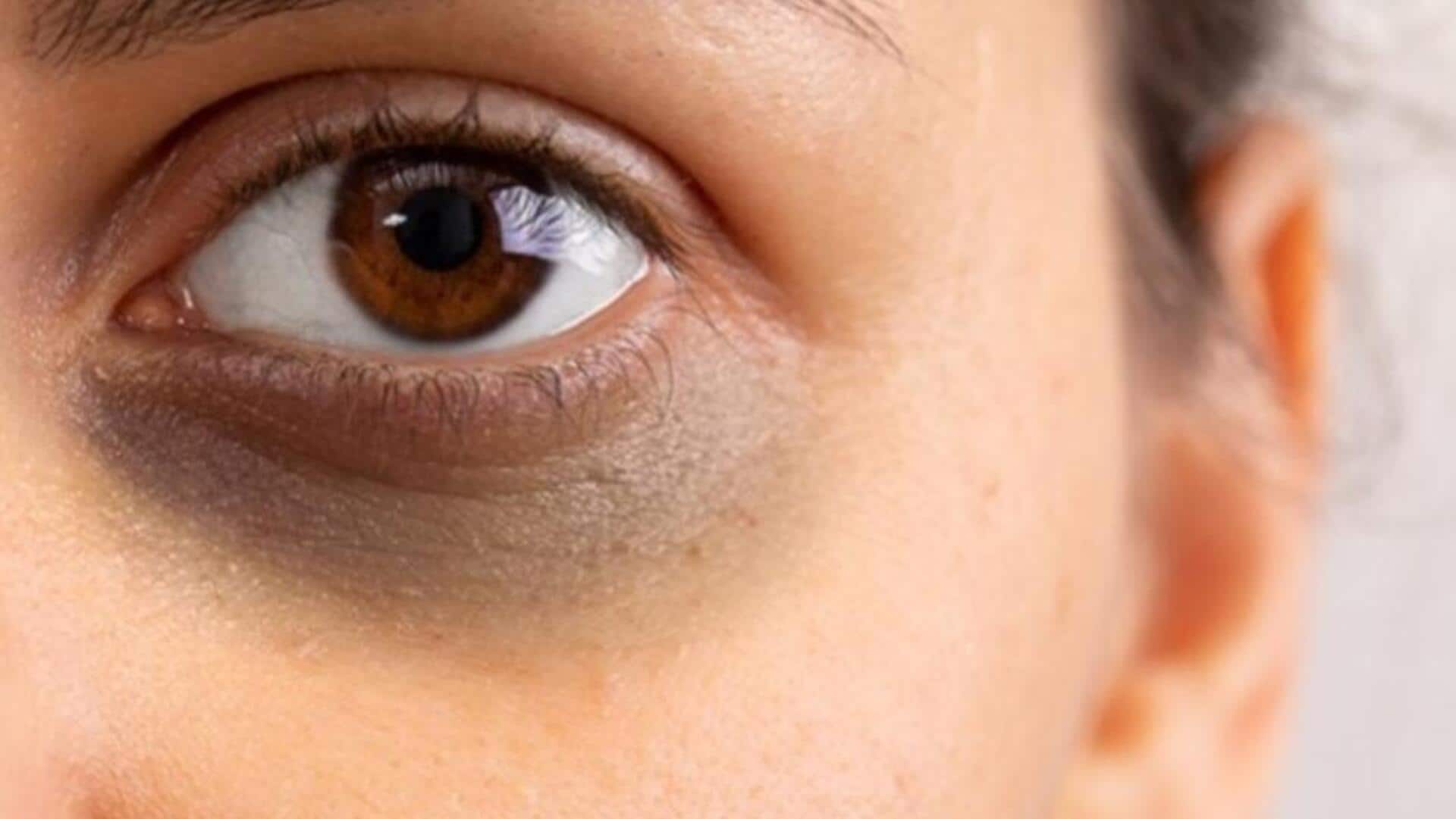 Dark circles? Try these remedies