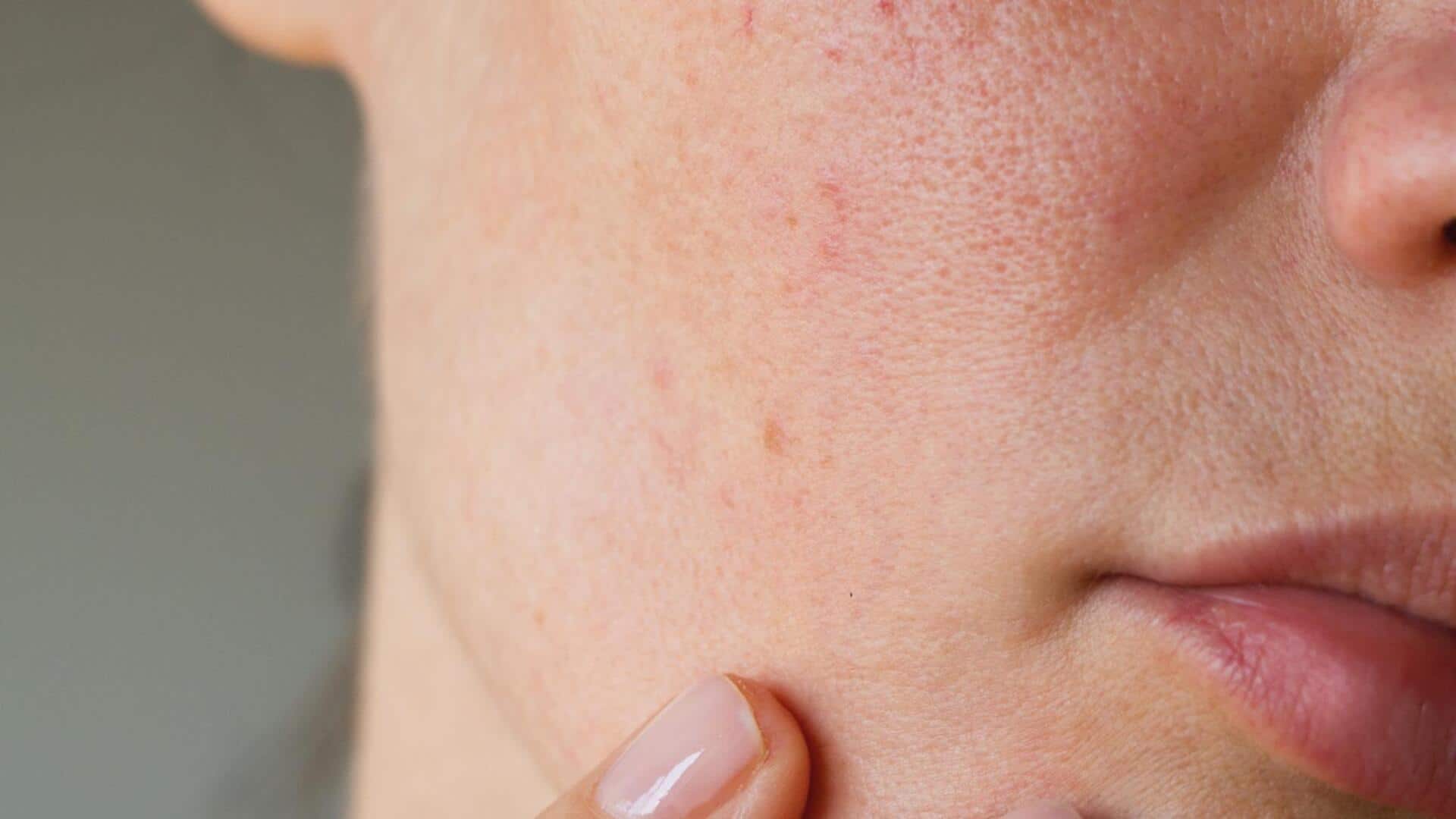 Home remedies to fix mild facial redness