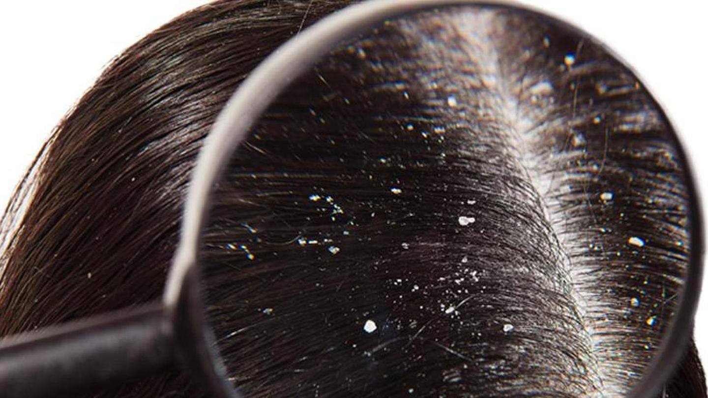 Try these oils to reduce dandruff from your scalp