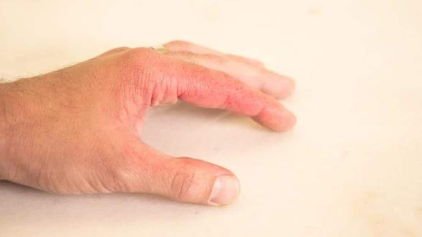 First-degree burns can be healed at your home; here's how