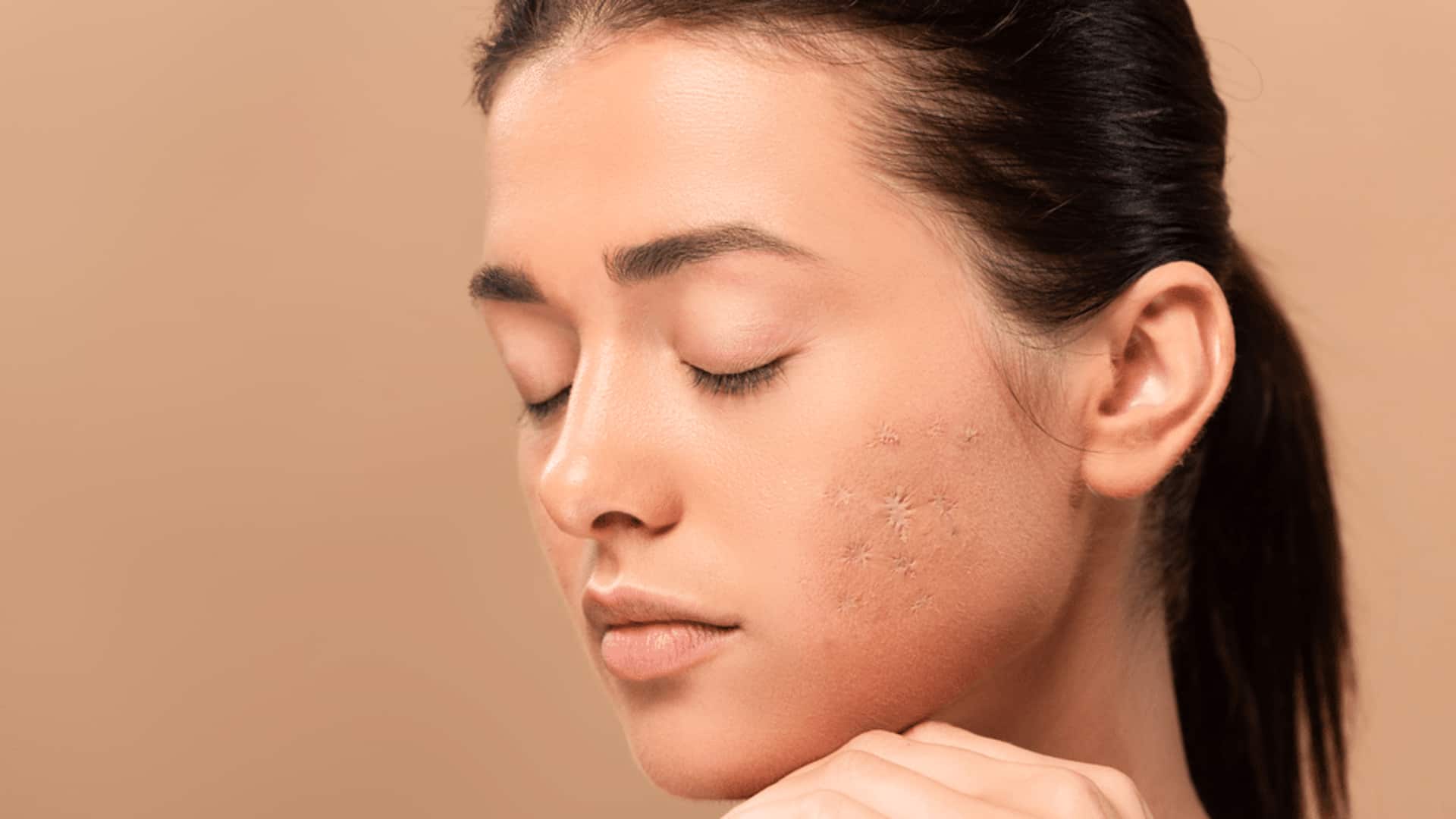 These home remedies will help fade stubborn acne scars 