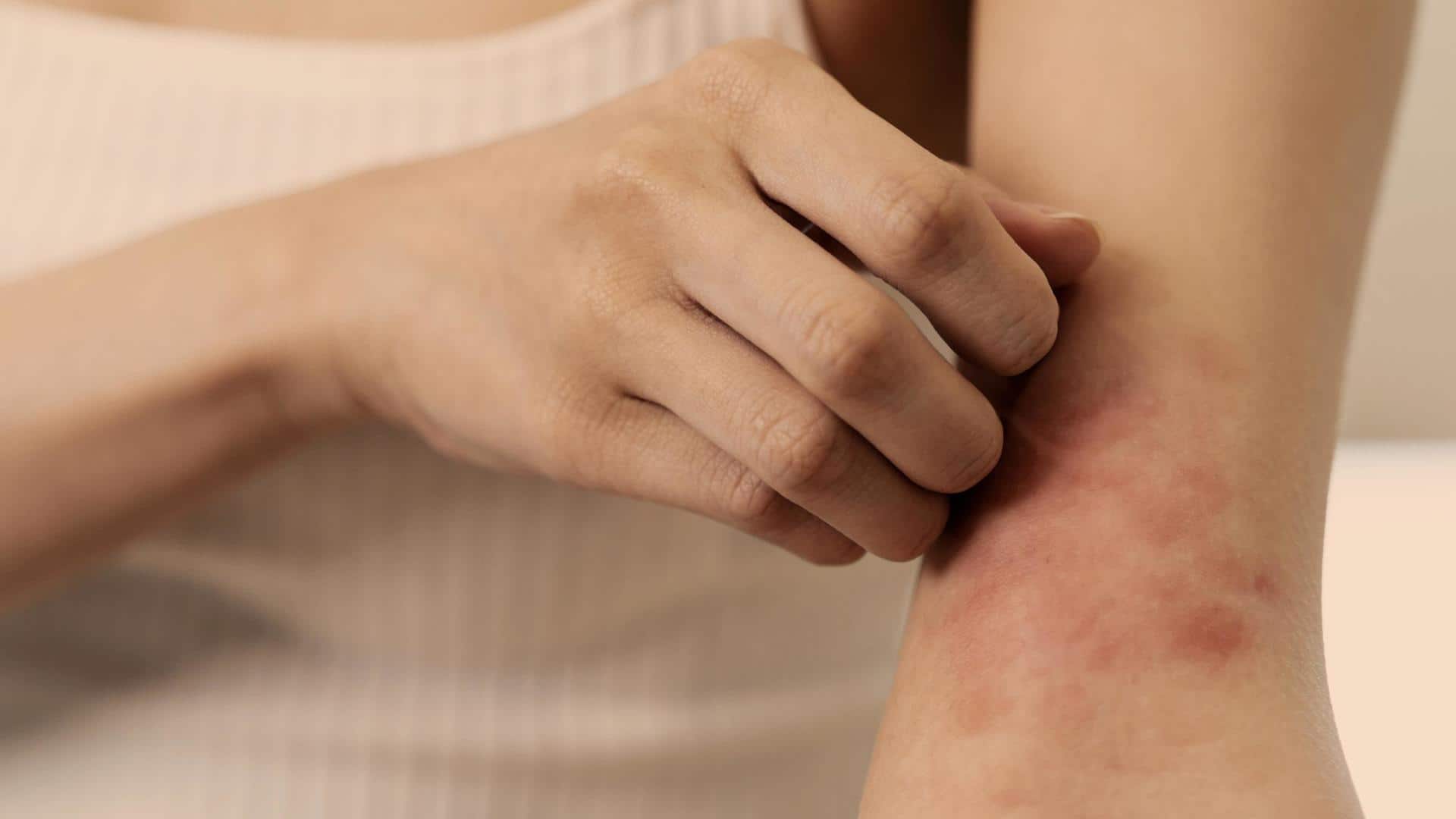 Dealing with skin rashes is easy with these home remedies