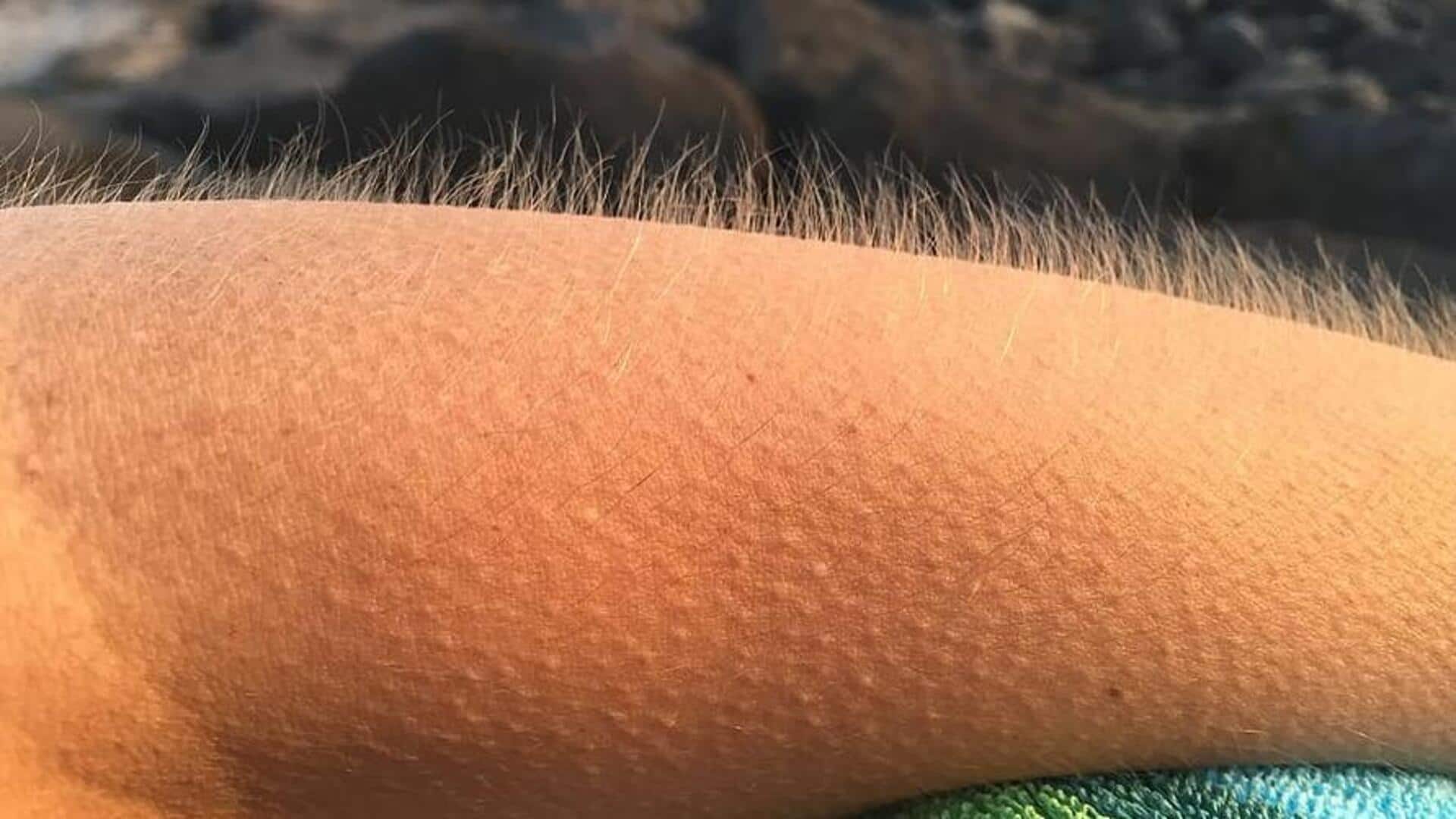 Goosebumps: How do they occur and when 