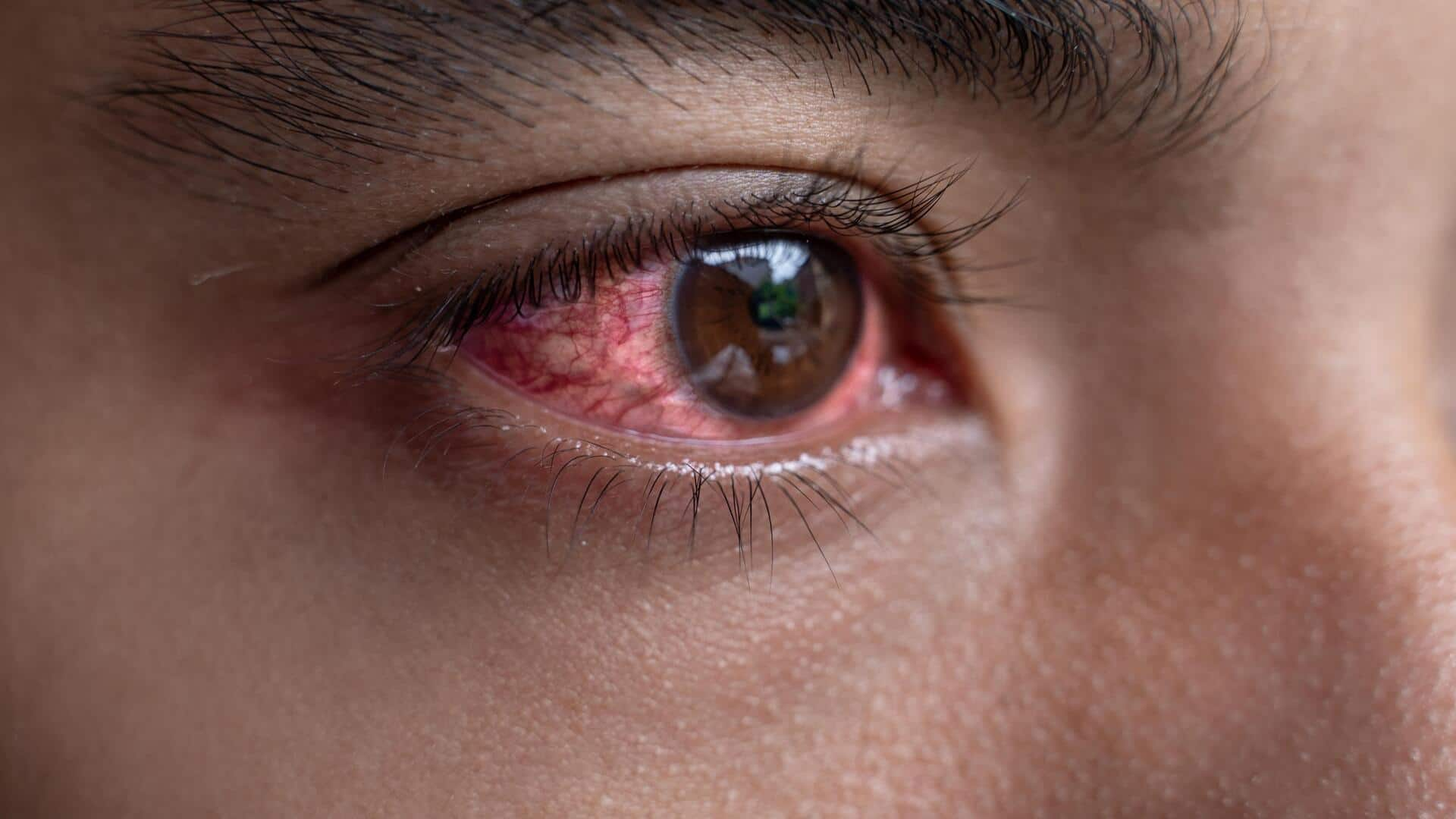 Conjunctivitis: Foods that foster healing from this eye infection