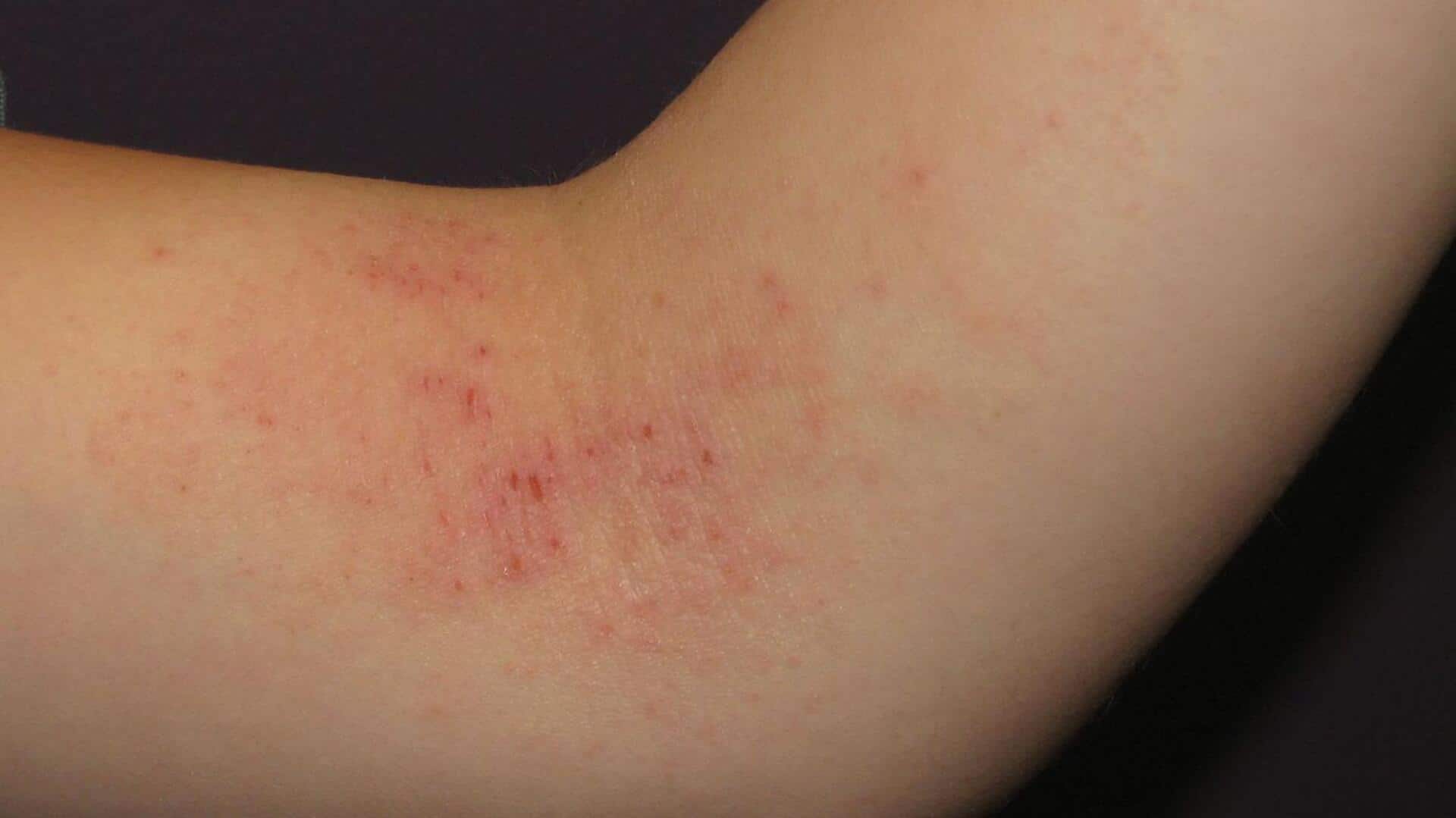 How to use carrot paste for skin rashes