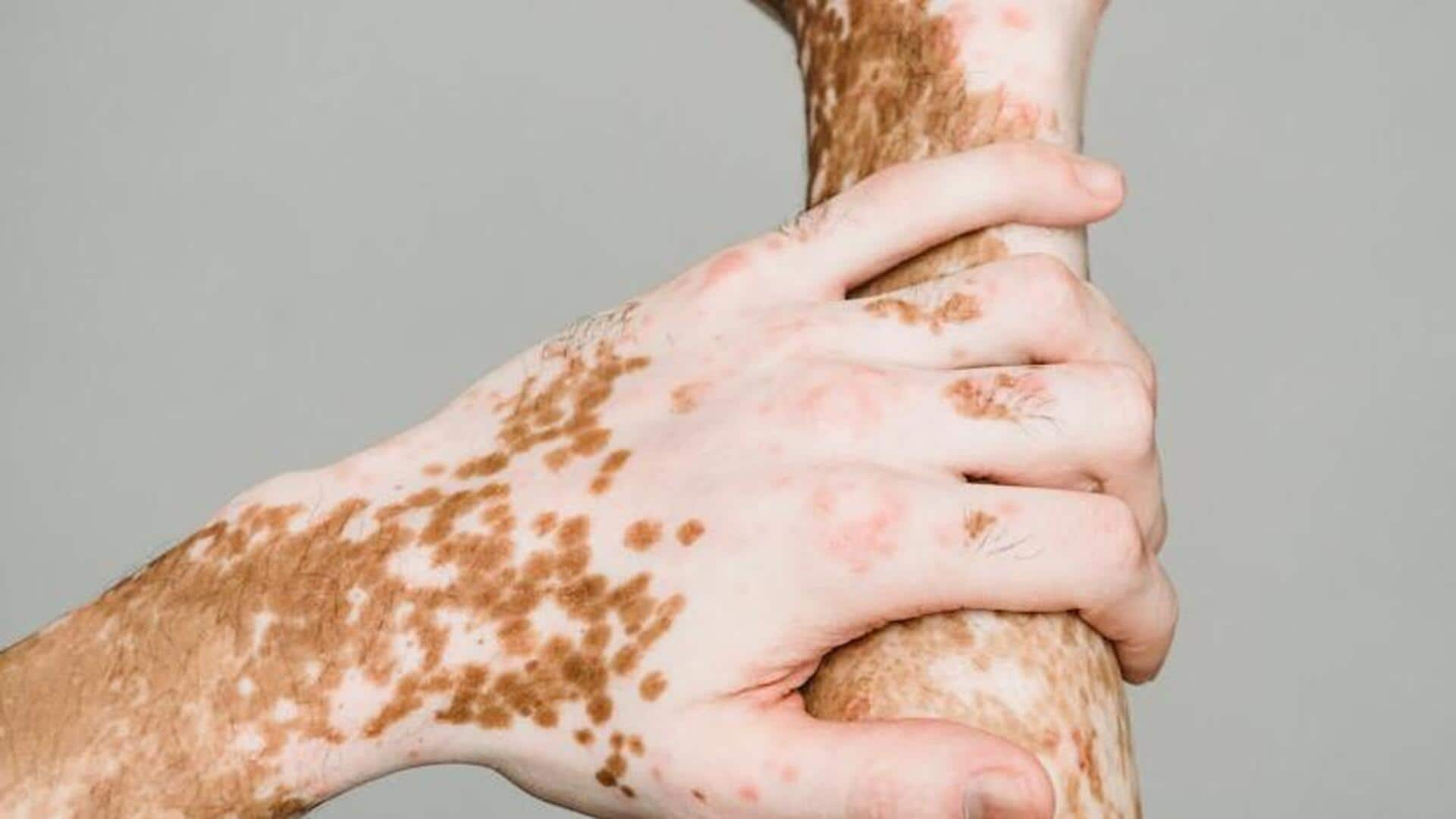 Vitiligo and sun exposure: Busting common myths