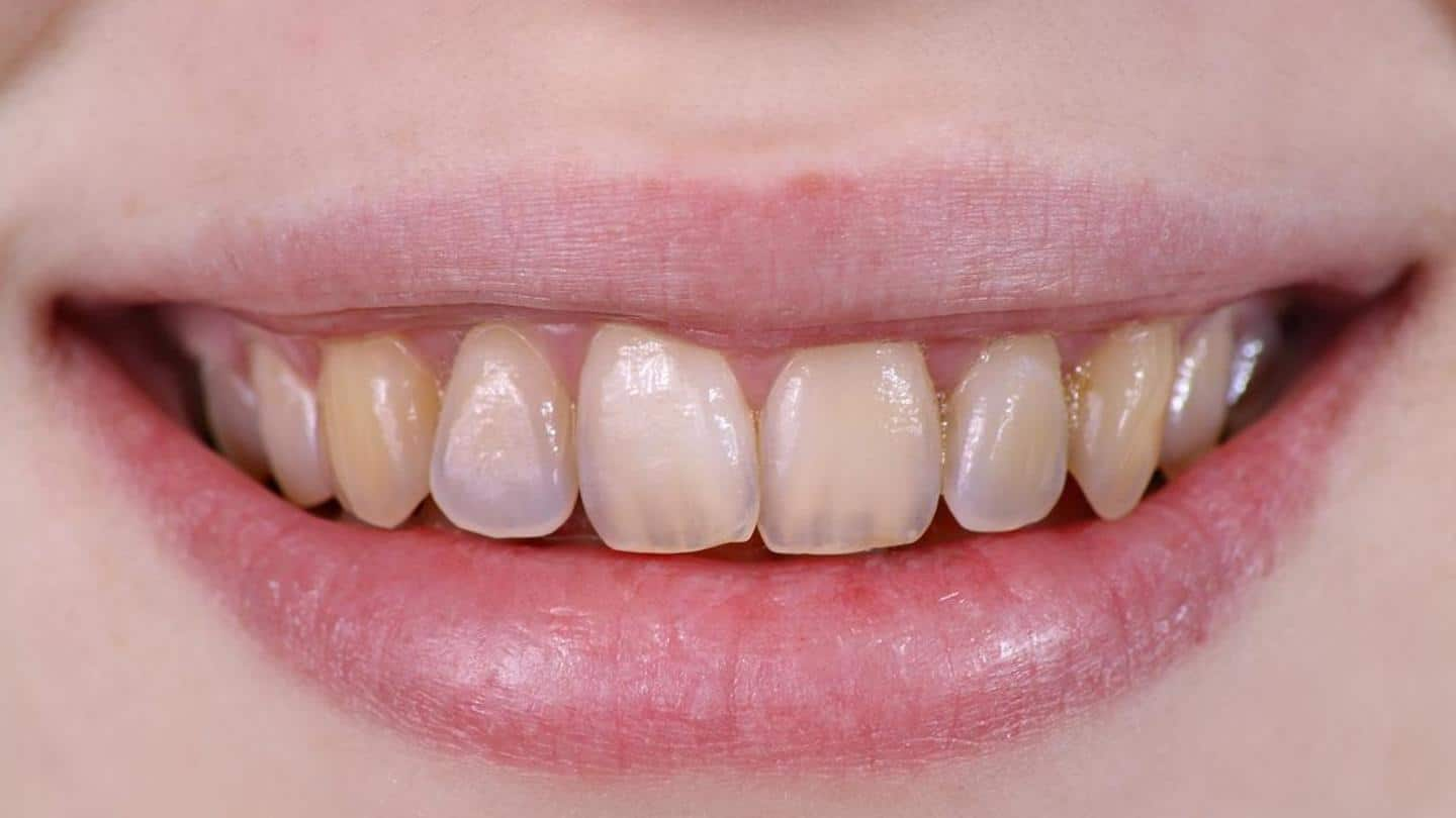 Four home remedies to remove accumulated tartar from teeth