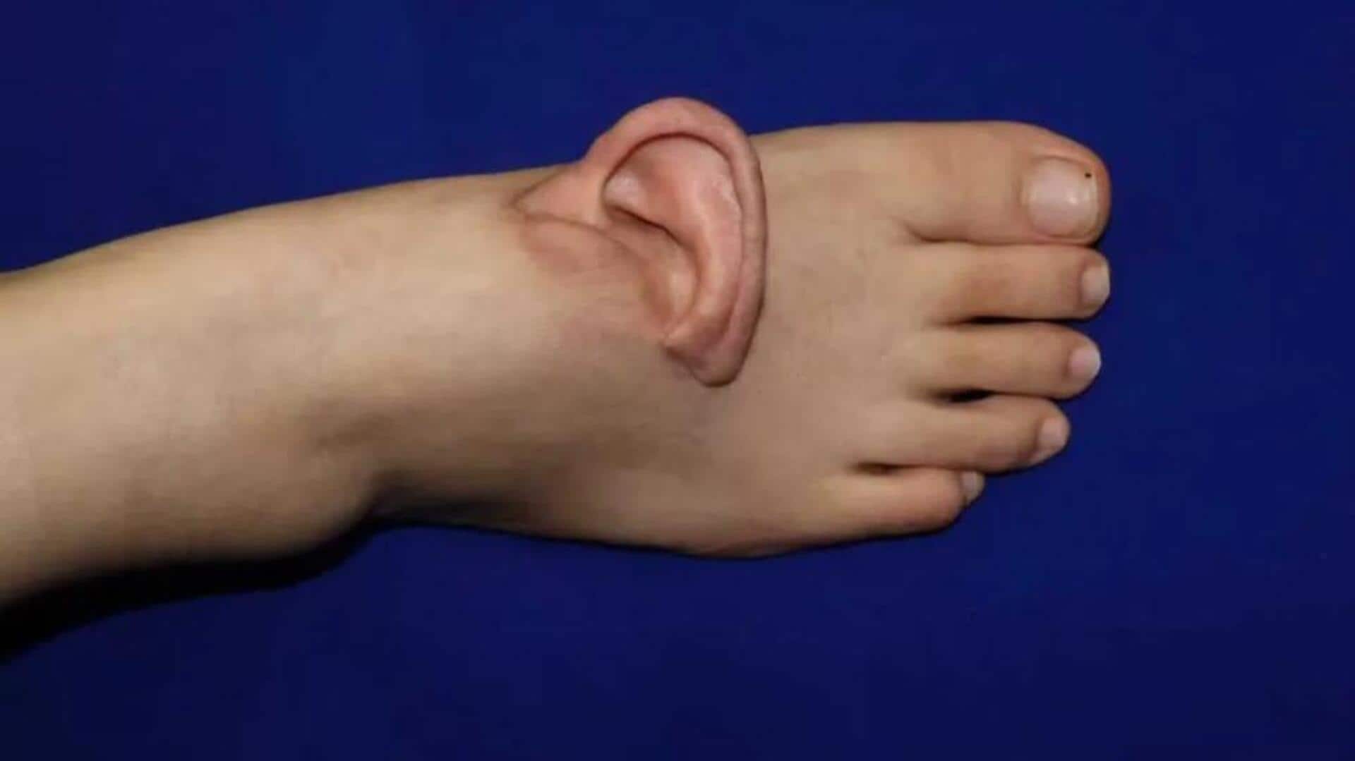 First-in-history: Chinese doctors save severed ear by grafting on foot