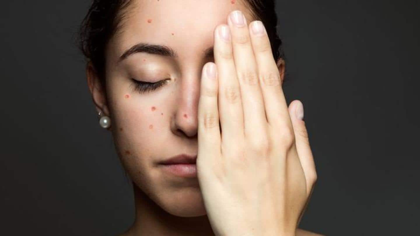 Chickenpox: These remedies will help lighten and fade chickenpox scars