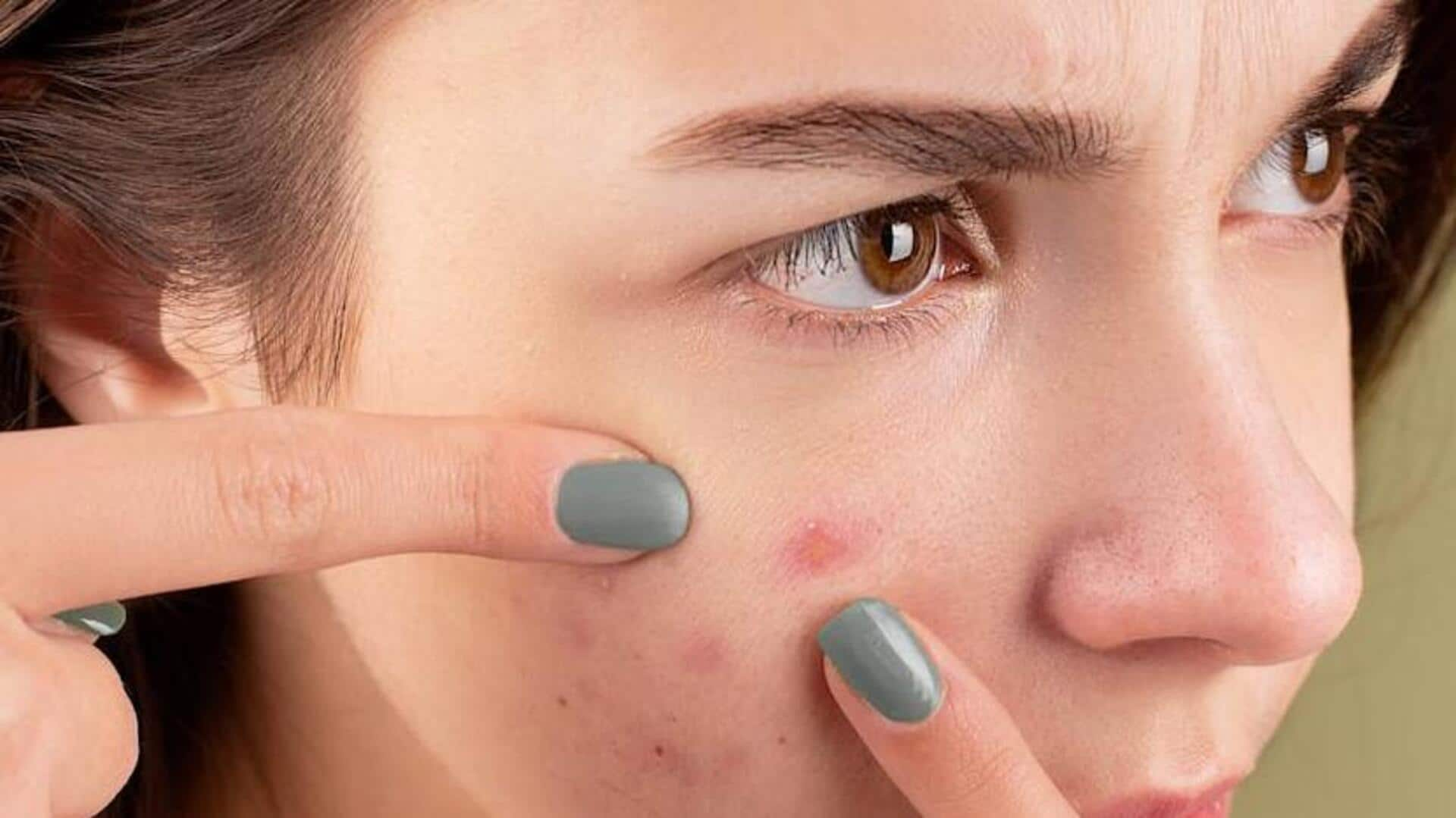 Natural remedies for acne from your kitchen