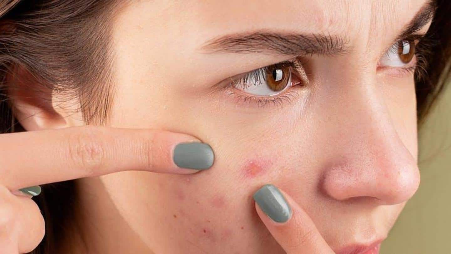 5 best ingredients that fight acne