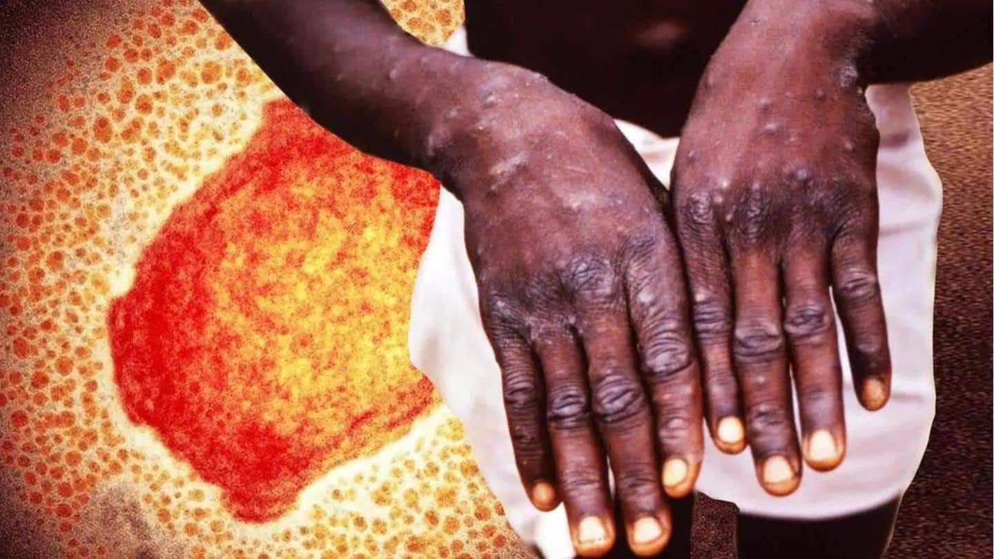 WHO confirms over 1,000 monkeypox cases in 29 countries