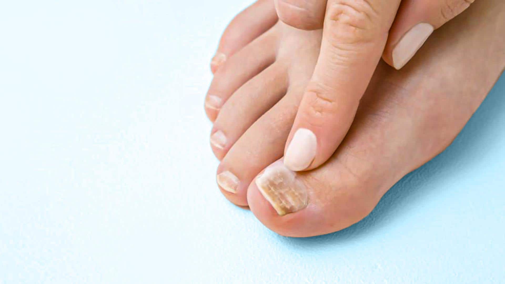 5 effective home remedies to treat toenail fungus