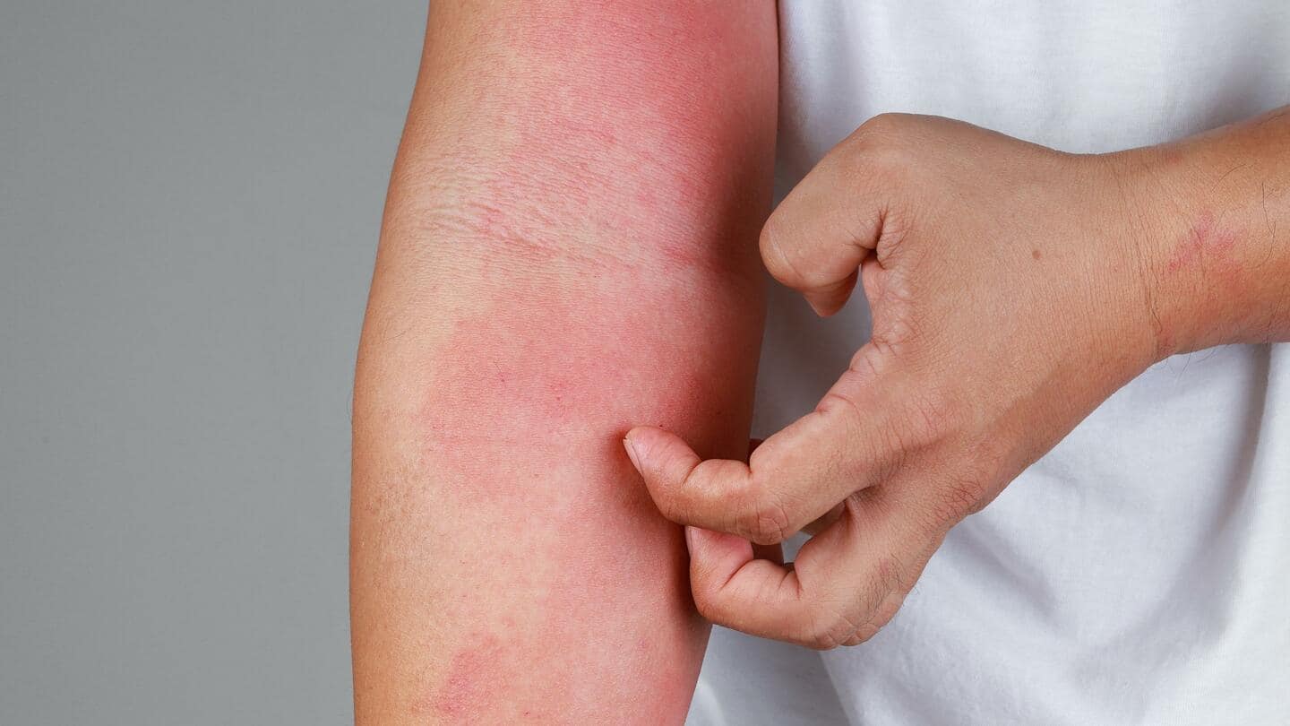 All about skin eczema: Symptoms, causes, types, and treatment