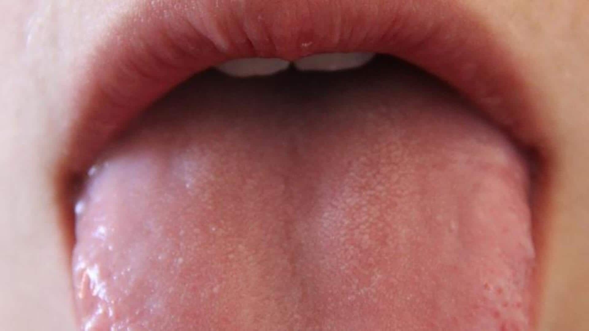 Home remedies for mild tongue discoloration