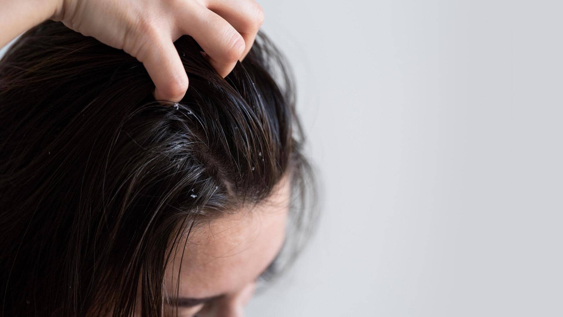 Suffering from scalp acne? Here are 5 natural remedies