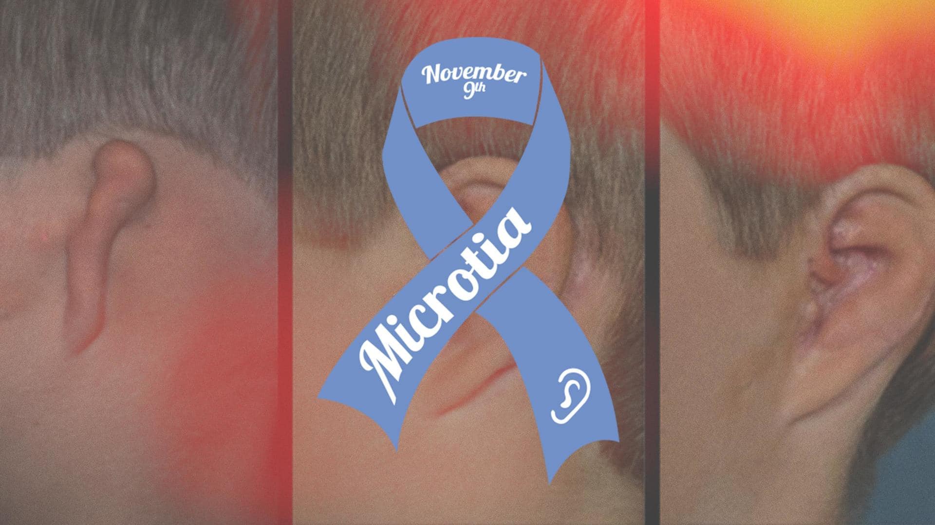 Microtia Awareness Day 2022: Here's everything to know about it