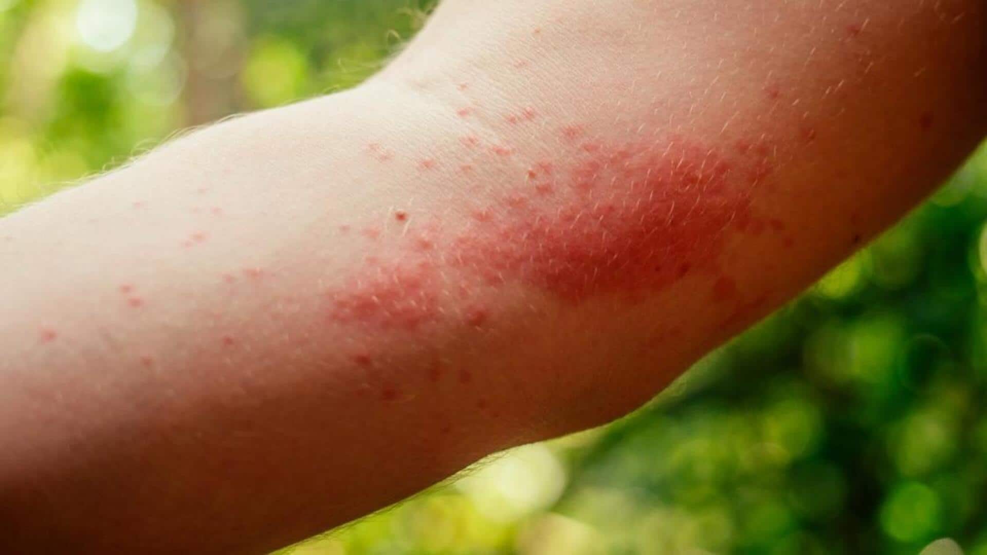 Soothe itchy insect bites with these home remedies Soothe itchy insect bites with these home remedies