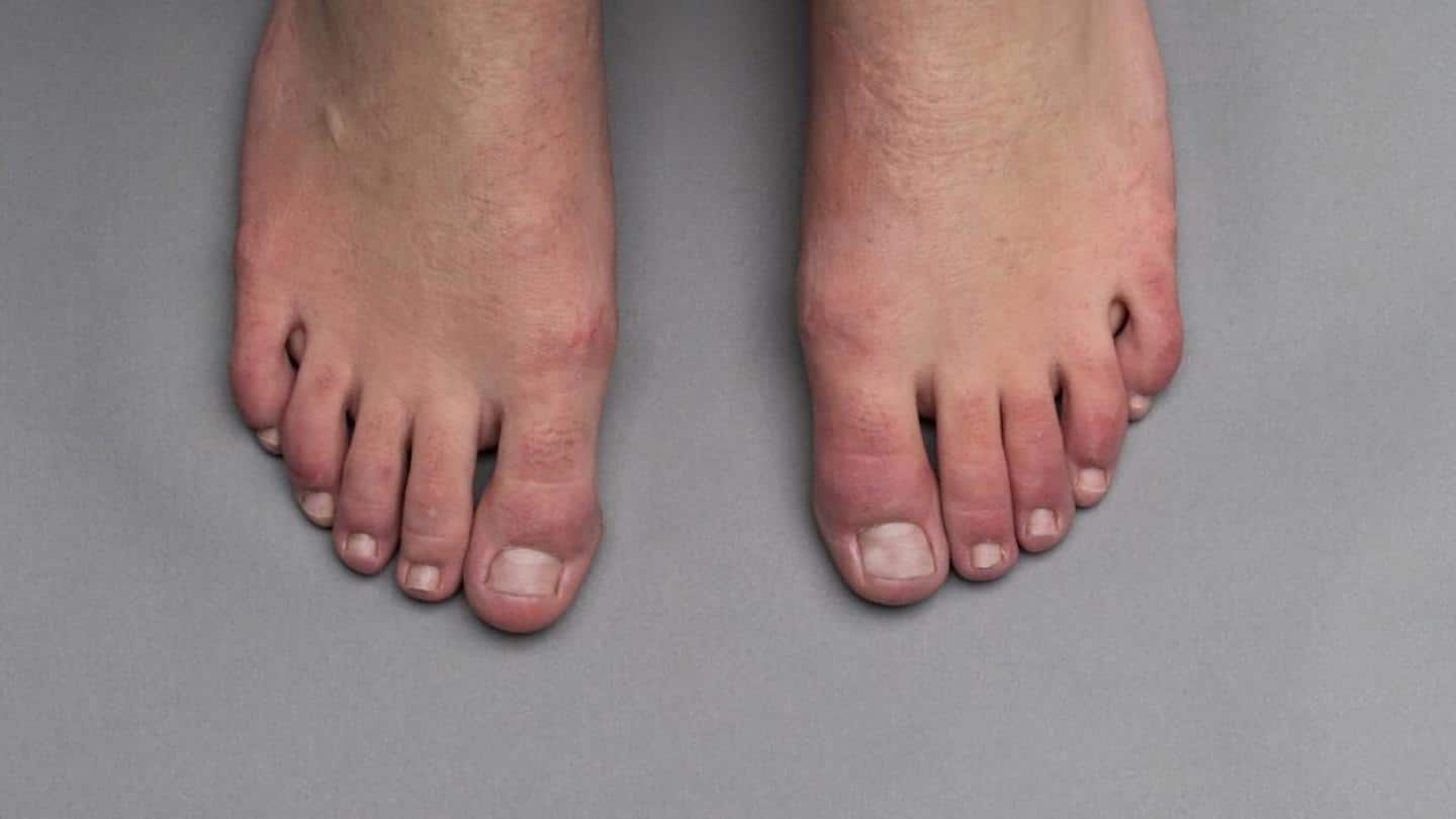 COVID toes: Causes, symptoms, and everything you should know