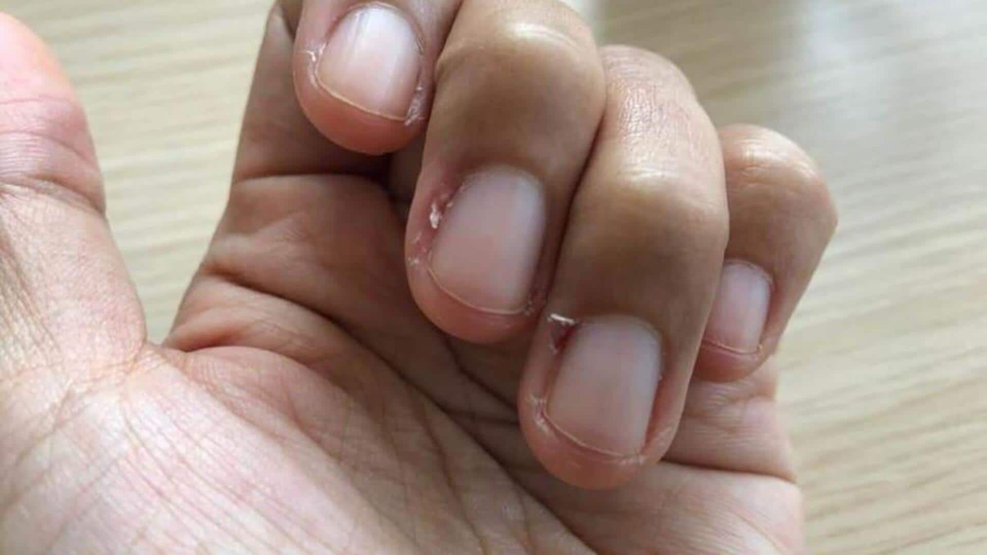 Fix hangnail pain with these home remedies