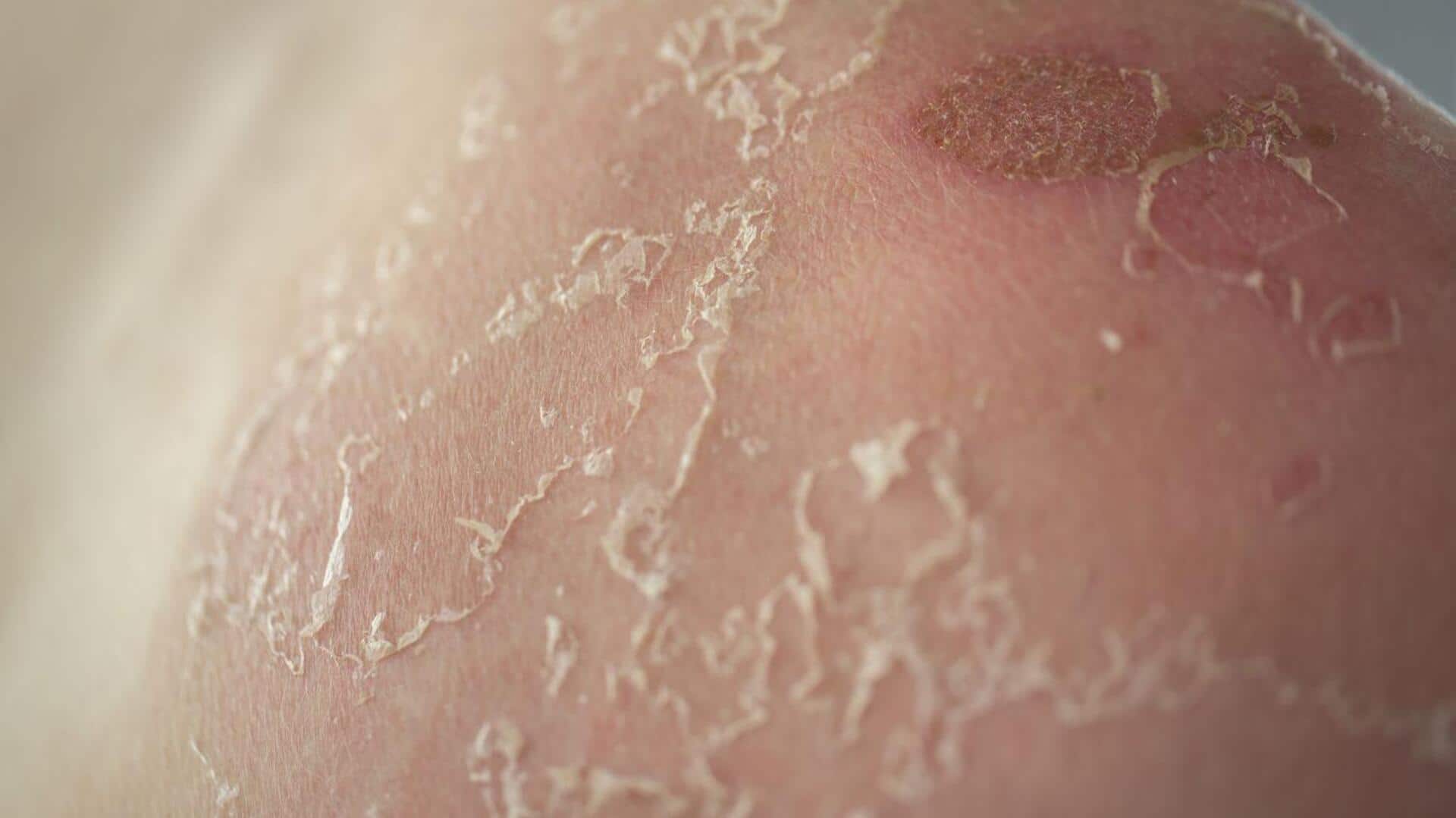 Fix flaky chest skin with these home remedies