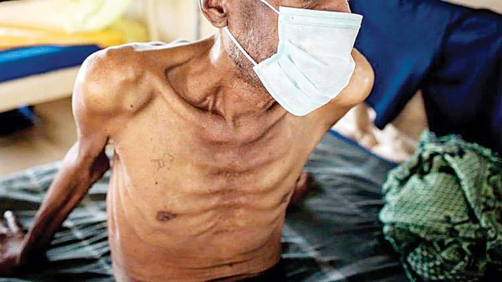 WHO issues new guidelines on tuberculosis and undernutrition