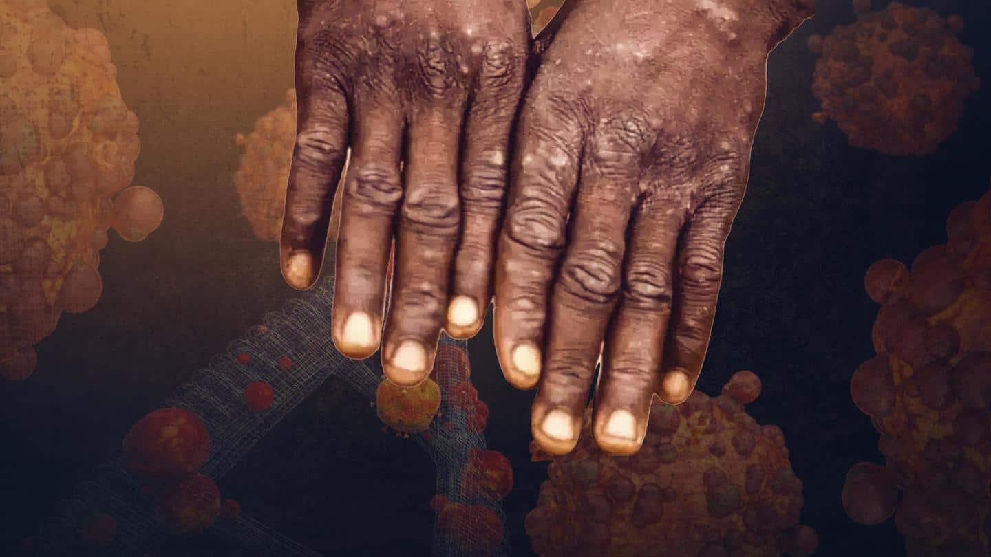 Delhi reports fifth monkeypox case, takes national tally to 10