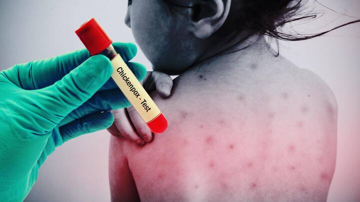 Chickenpox: Meaning, causes, symptoms, and treatment