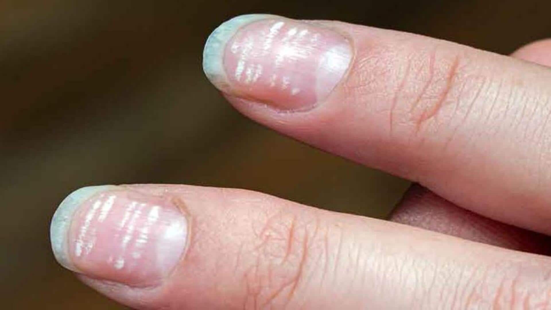 Here's what the white spots on your nails indicate 
