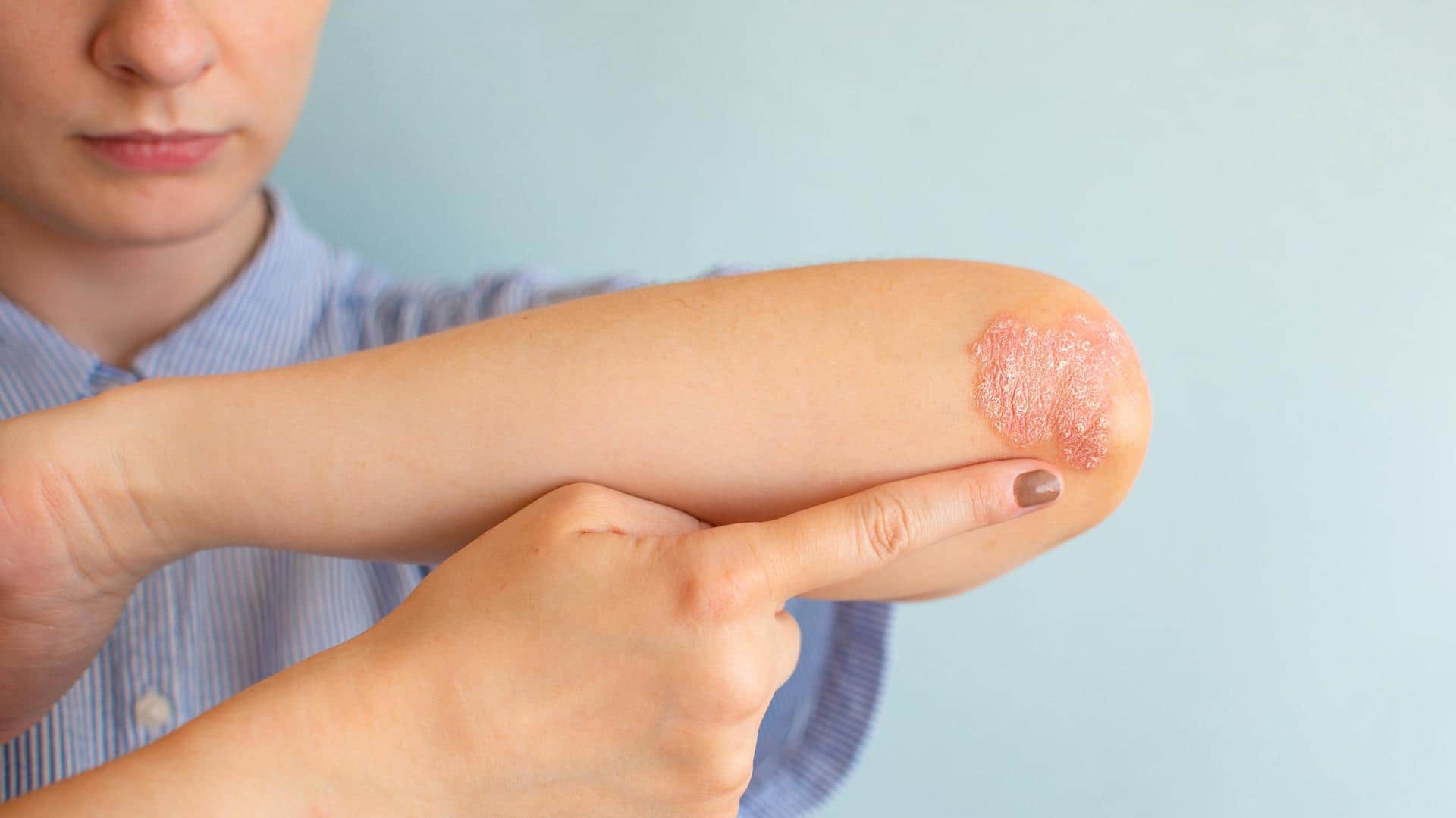 Home remedies for ringworm: How to treat this condition naturally