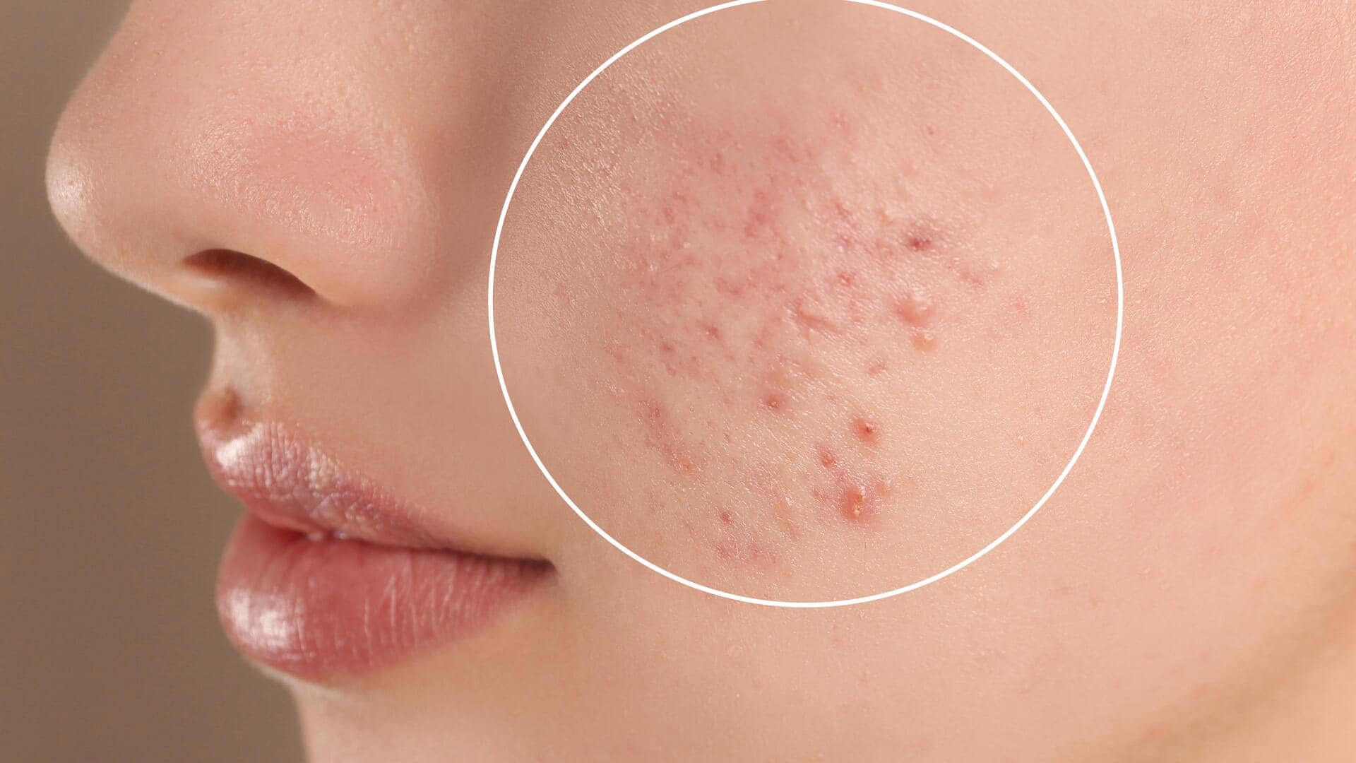 Foods you didn't know can cause acne breakouts