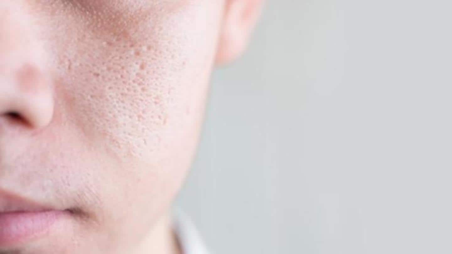 Pores cannot be removed completely; toner minimizes their appearance though Pores cannot be removed completely; toner minimizes their appearance though