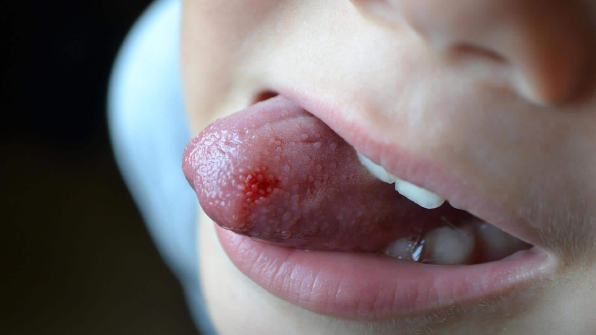 Suffering from tongue blisters? Try these home remedies