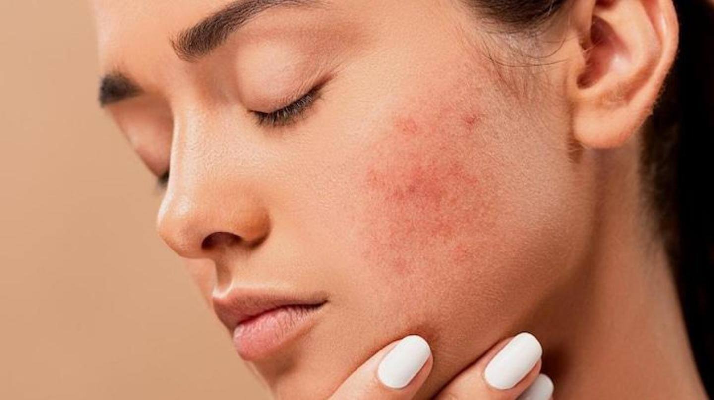 Doesn't strip skin of its natural oils, prevents acne Doesn't strip skin of its natural oils, prevents acne