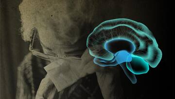 Alzheimer's drug succeeded in slowing cognitive decline, say drugmakers